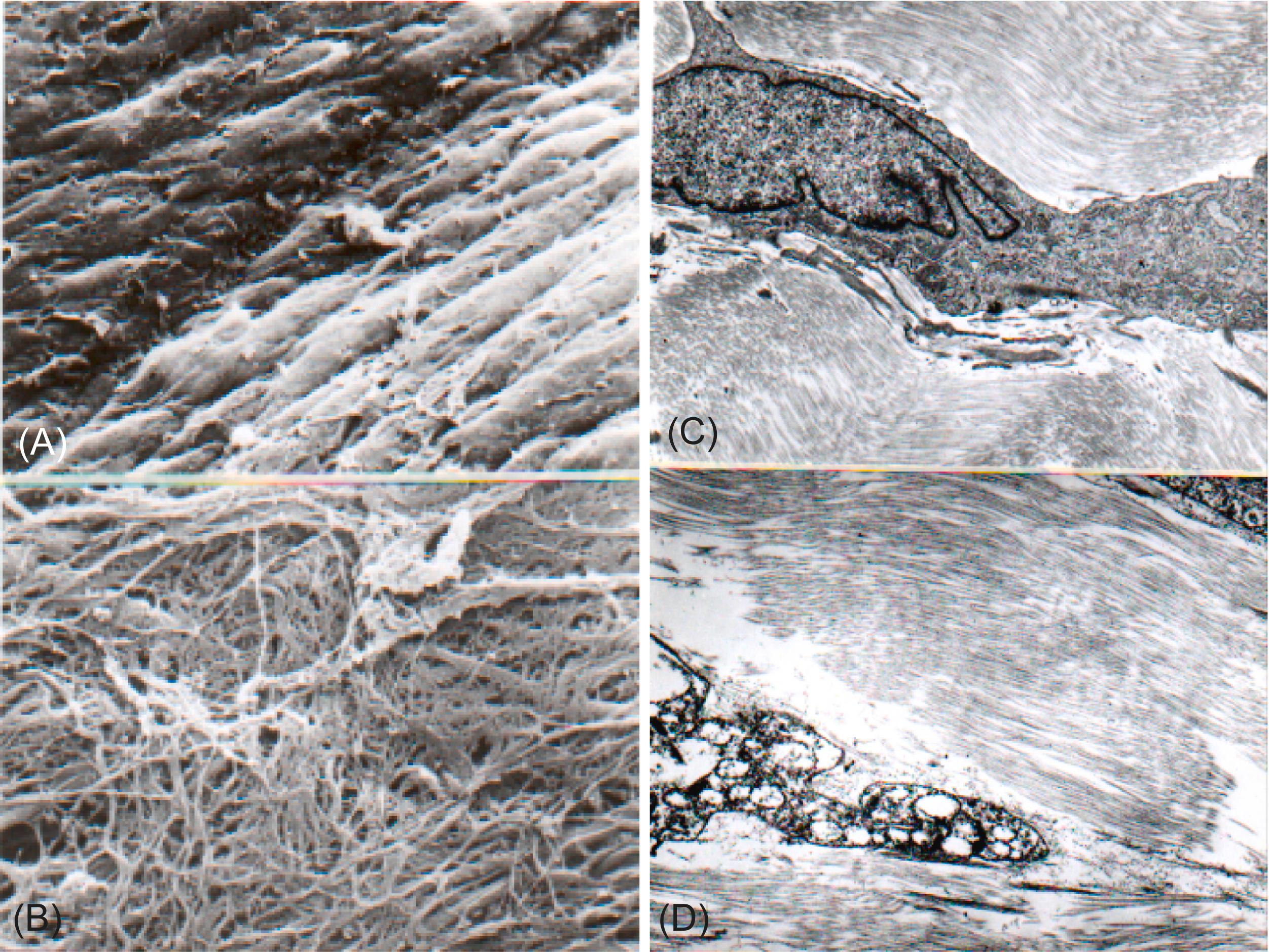 Figure 17.6, Structural alterations induced by preservation and fabrication of a porcine aortic valve into a bioprosthesis. Scanning electron microscopy appearance of the surface of (A) fresh porcine valve and (B) porcine bioprosthesis before implantation. Confluent endothelial layer present in fresh porcine aortic valve is entirely lost in the fabricated valve. A rough, fibrillar basement membrane forms the blood-contacting surface of a commercially produced valve shown in (B). (C and D) Transmission electron microscopy of deep portions of valve illustrating degrees of cellular preservation and collagen waviness. (C) Freshly fixed porcine aortic valve, with morphologically normal cell, wavy collagen, and close apposition of cell to fibrillar and amorphous extracellular matrix. Fabricated valve (high-pressure-fixed) has cellular autolysis and empty space between cells and collagen. Moreover, the collagen is flat in the high-pressure-fixed valve illustrated in (D) but wavy in the fresh aortic valve shown in (C). (C and D) 8000×.