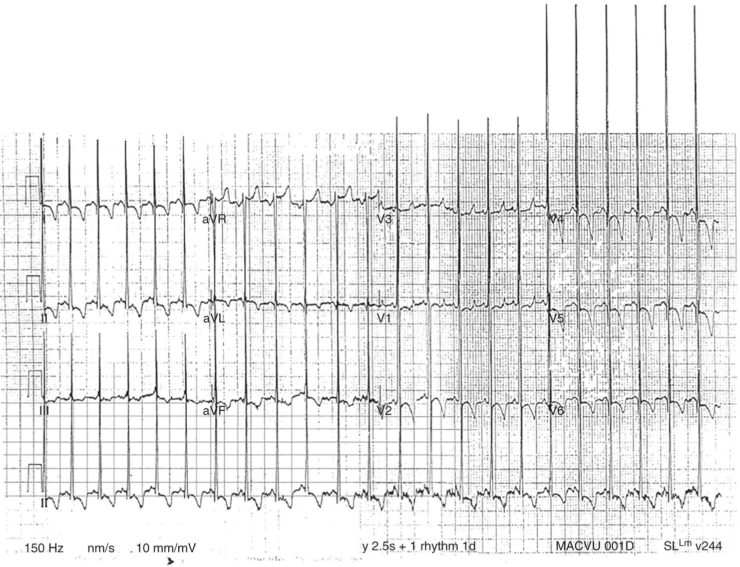 Fig. 59.1, Typical electrocardiogram of a patient with Pompe disease demonstrates striking biventricular hypertrophy.