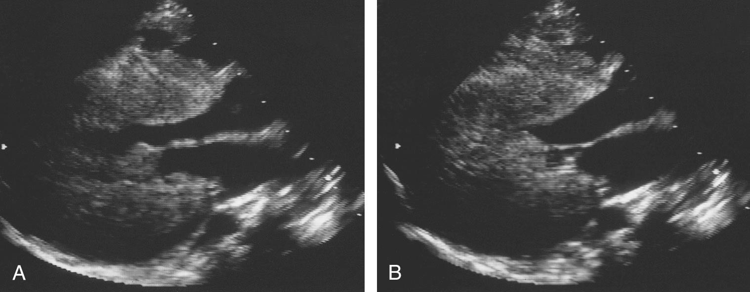 Fig. 59.2, Typical echocardiographic findings in glycogen storage disease type II. (A) Diastolic frame in long axis reveals severe concentric left ventricular hypertrophy, while the systolic frame from the same child (B) shows the absence of subaortic obstruction.