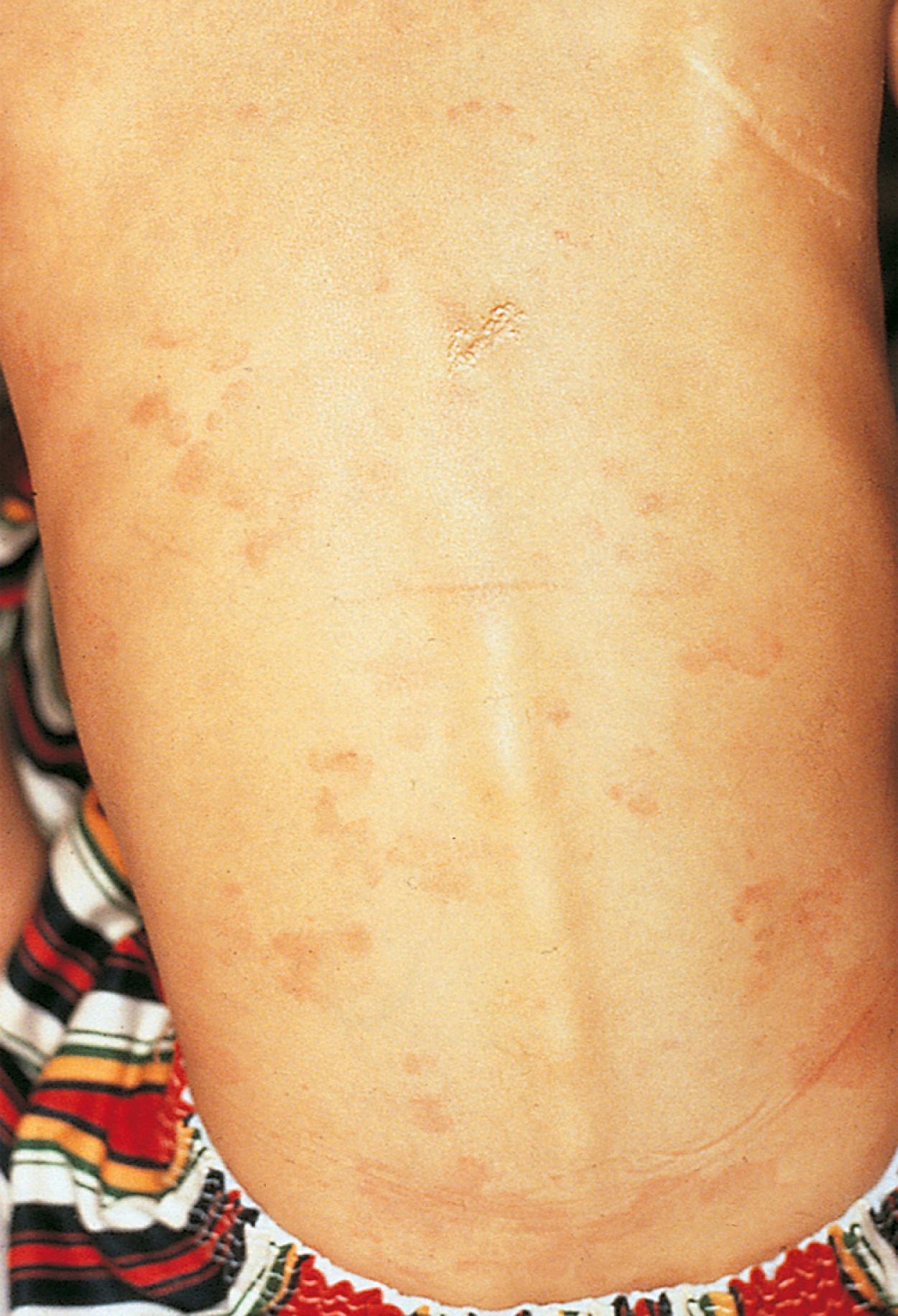 Fig. 5.11, Erythema marginatum rash in a child with acute rheumatic fever. Note the wavy margins in the distribution on the trunk.