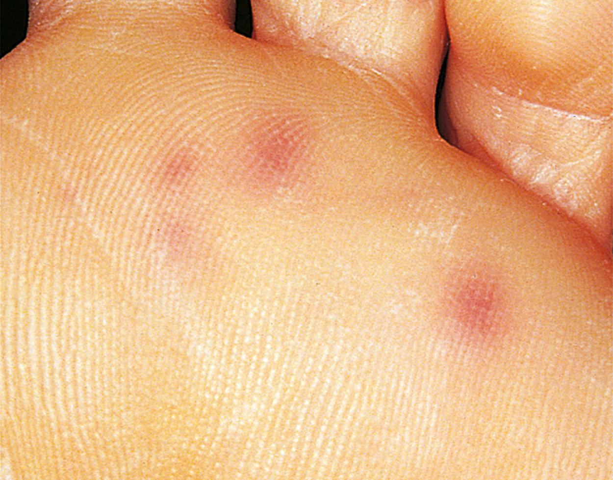 Fig. 5.13, Janeway lesions. Note the small (painless) nodules on the sole of a patient with bacterial endocarditis.