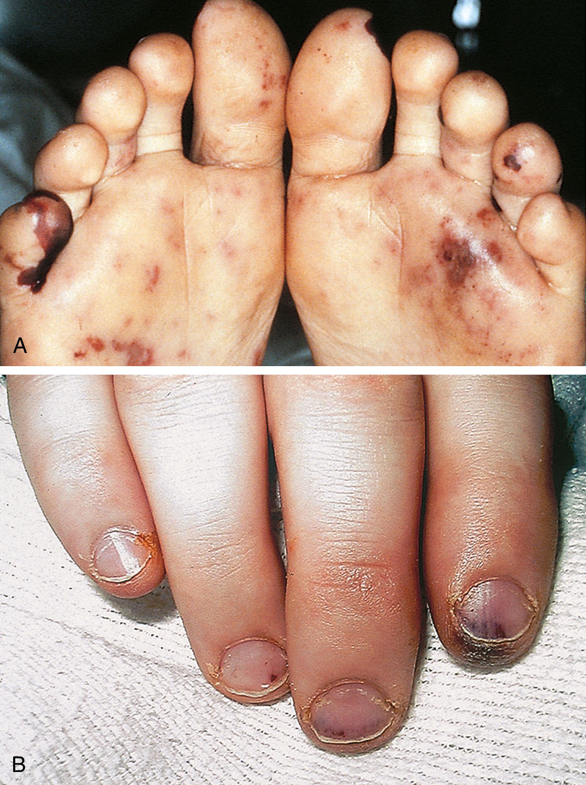 Fig. 5.14, Acute bacterial endocarditis. Note the hemorrhagic lesions (A) and subungual splinter hemorrhages (B).