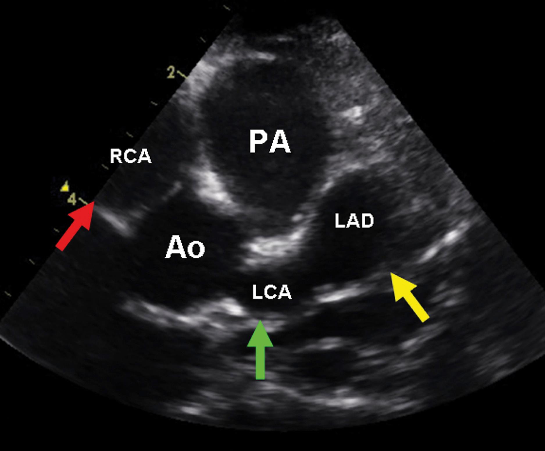 Fig. 5.16, Kawasaki disease: Giant coronary artery aneurysms. Multiple giant coronary aneurysms of the right (RCA, red arrow), left (LCA, green arrow), and left anterior descending (LAD, yellow arrow) coronary arteries. Ao, Aorta; PA, pulmonary artery.