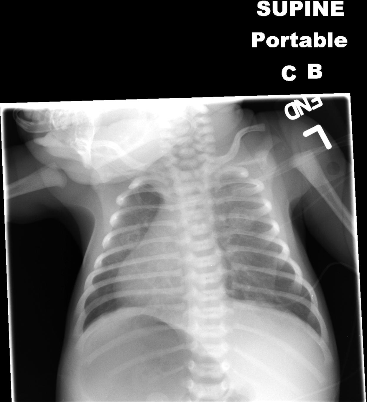 Fig. 5.18, Dextrocardia with situs inversus totalis. Note the cardiac apex pointing to the right along with the stomach bubble under the right diaphragm.