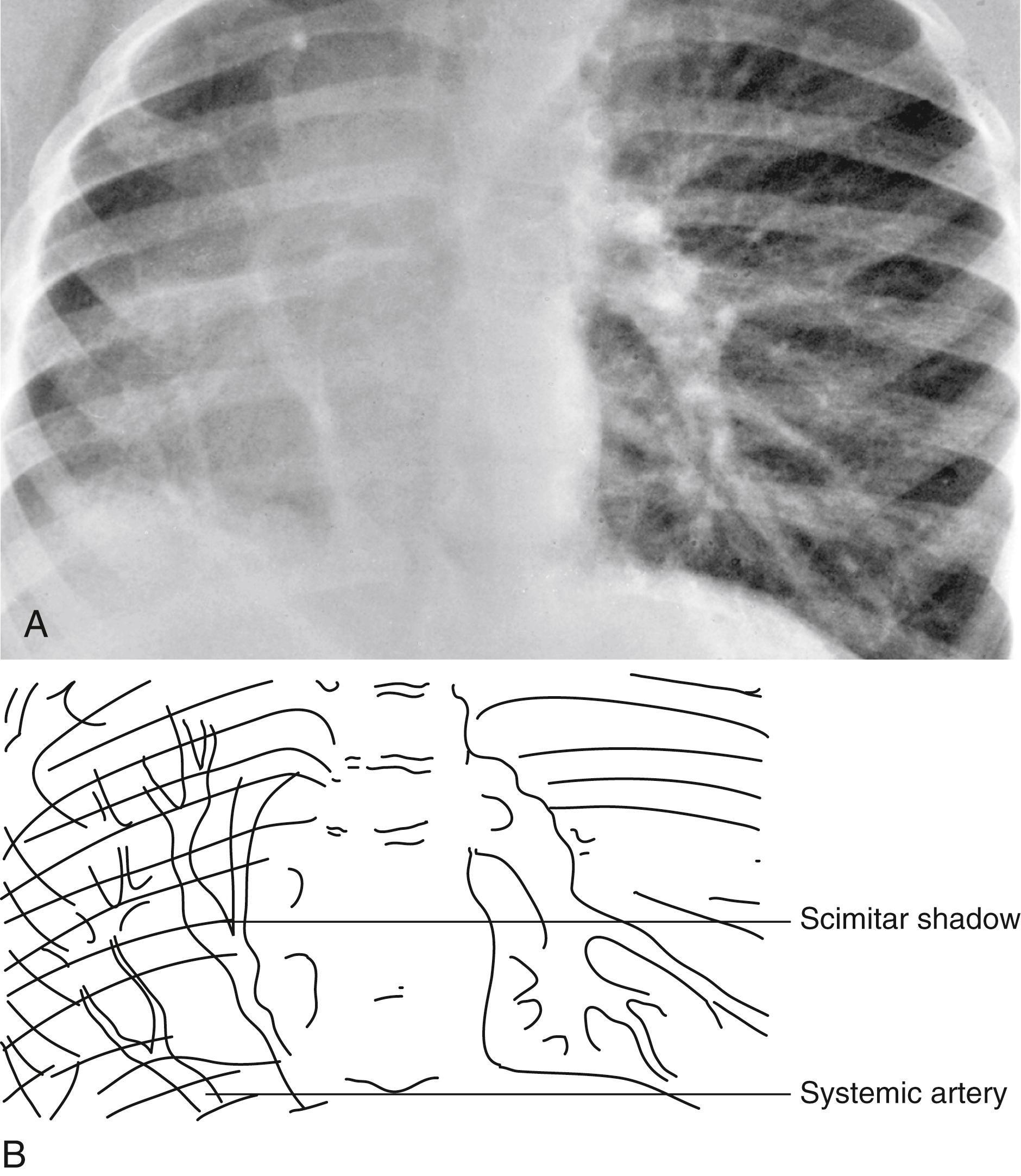 Fig. 5.19, Scimitar syndrome. (A) Note the hypoplastic right lung and scimitar-shaped shadow formed by pulmonary veins draining the sequestered segment and connecting to the inferior vena cava. (B) Note also the systemic artery coursing diagonally upward from the abdominal aorta to the sequestered lobe.