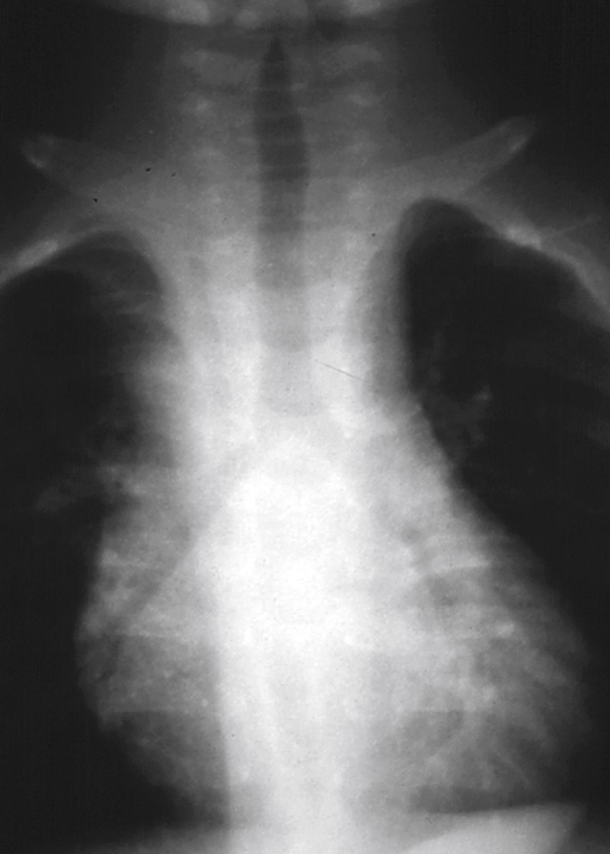 Fig. 5.20, Atrial isomerism. Note the symmetric bronchial anatomy. Atrial isomerism should be suspected when the heart is midline on the chest radiograph and situs ambiguous is present. The best radiographic sign of right or left atrial isomerism pertains to the symmetry of bronchial anatomy, with right atrial isomerism being related to bilateral right bronchi and left atrial isomerism to bilateral left bronchi.