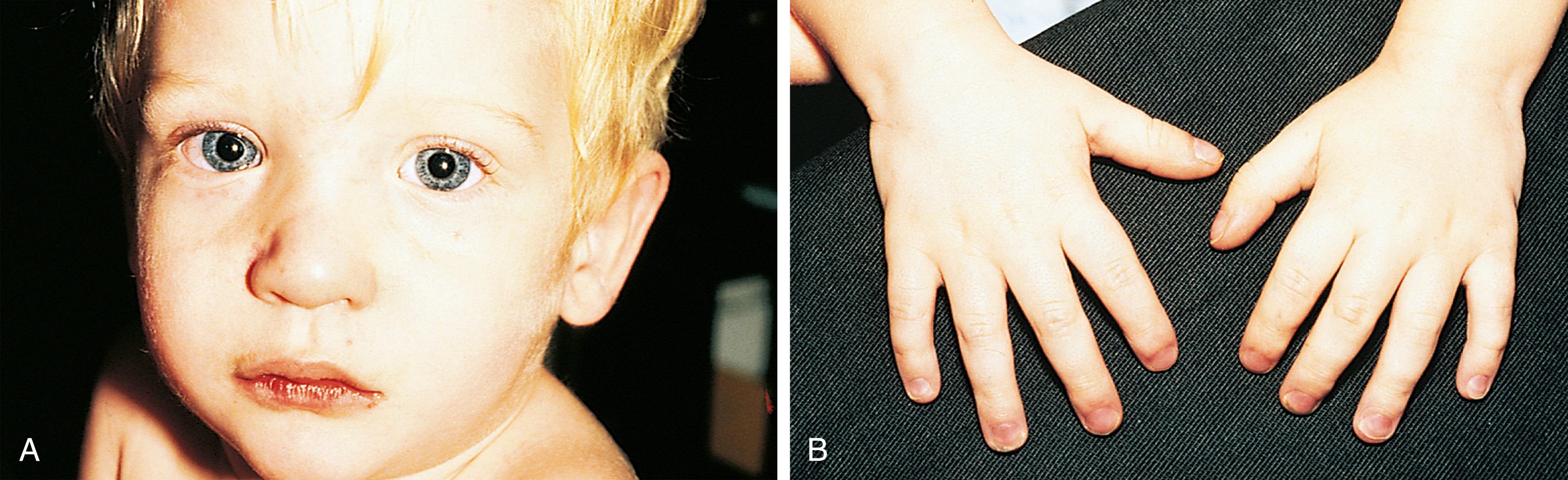 Fig. 5.2, Moderate cyanosis. This child demonstrates moderate cyanosis of the lips (A) and nails (B). Note also the reddish discoloration of the eyes resulting from conjunctival suffusion.