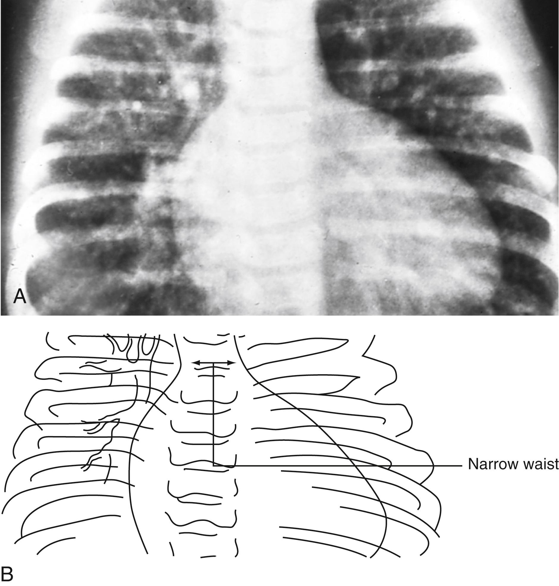 Fig. 5.21, Transposition of the great arteries. (A and B) Note the “egg on a string” heart shadow, which results from the position of the main pulmonary artery posterior and slightly to the left of the aorta, contributing to the narrow waist (the “string”).