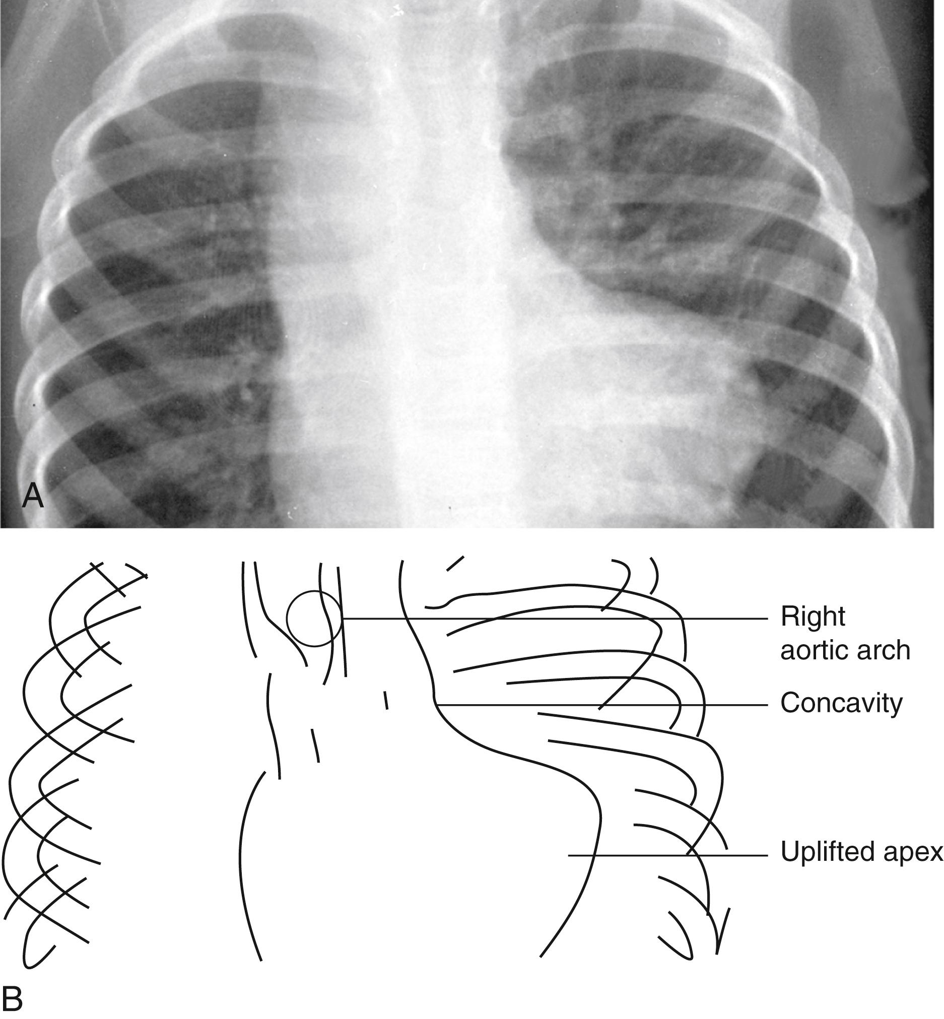 Fig. 5.22, (A and B) Tetralogy of Fallot with pulmonic stenosis produces a “boot-shaped” heart, which results from right ventricular hypertrophy, upward tilt of the apex, and the concavity at the left upper heart border caused by a small right ventricular infundibulum and main pulmonary artery. Note also the right aortic arch.