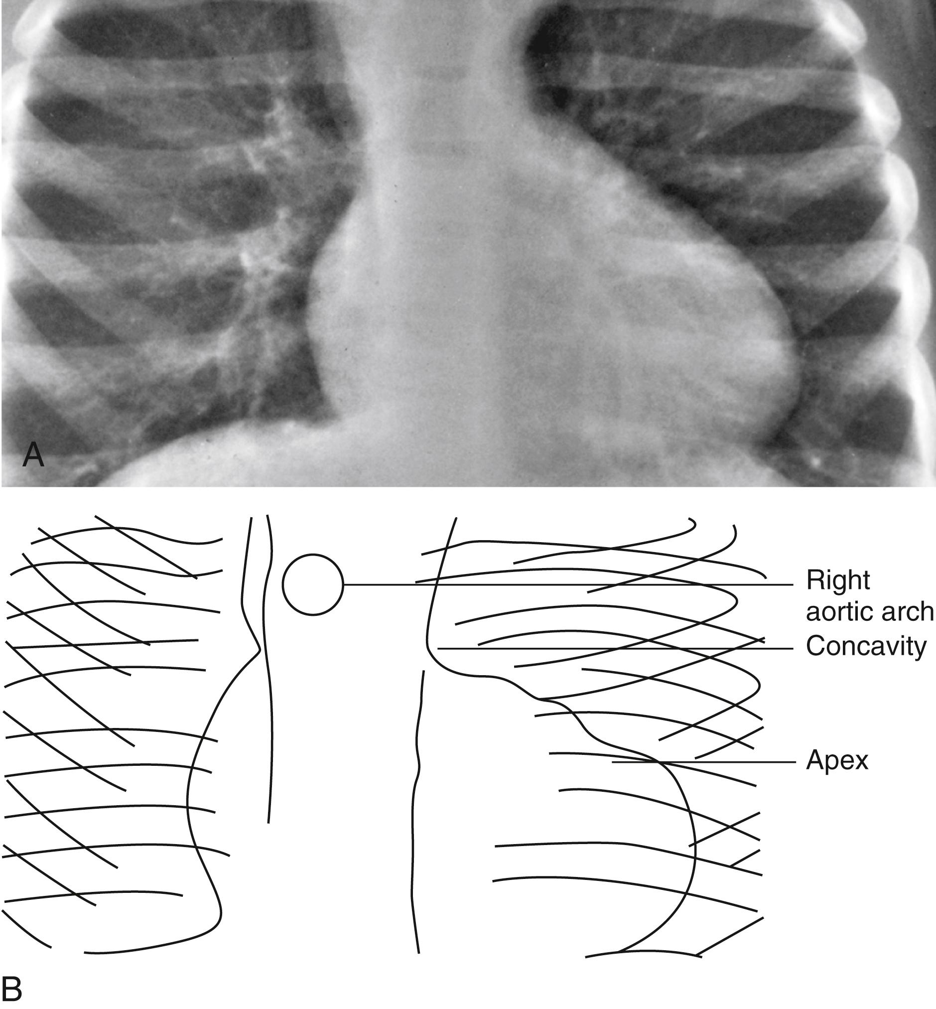 Fig. 5.23, Tetralogy of Fallot with pulmonary atresia. (A and B) Note the “egg on its side” appearance of the heart due to the uplifted apex resulting from the right ventricular hypertrophy. The absence of a right ventricular outflow and the diminutive main pulmonary artery segment produce a concavity at the left upper heart border. Note also that a right aortic arch is present.