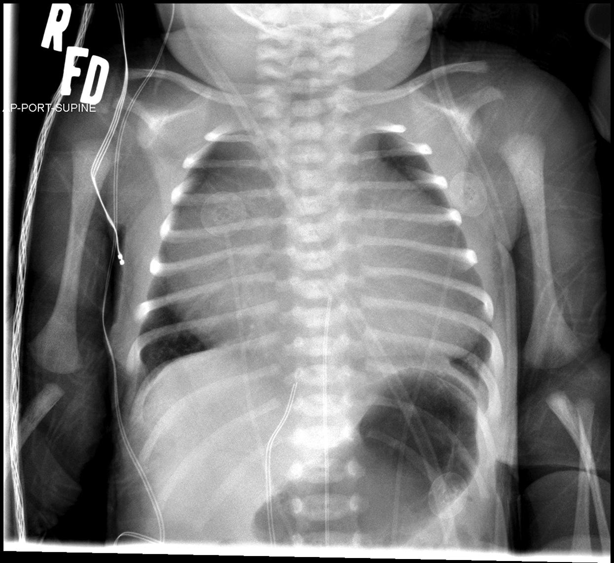 Fig. 5.24, Ebstein anomaly of the tricuspid valve. Note the radiographic appearance of the “wall-to-wall” heart, due to a massively enlarged right atrium.