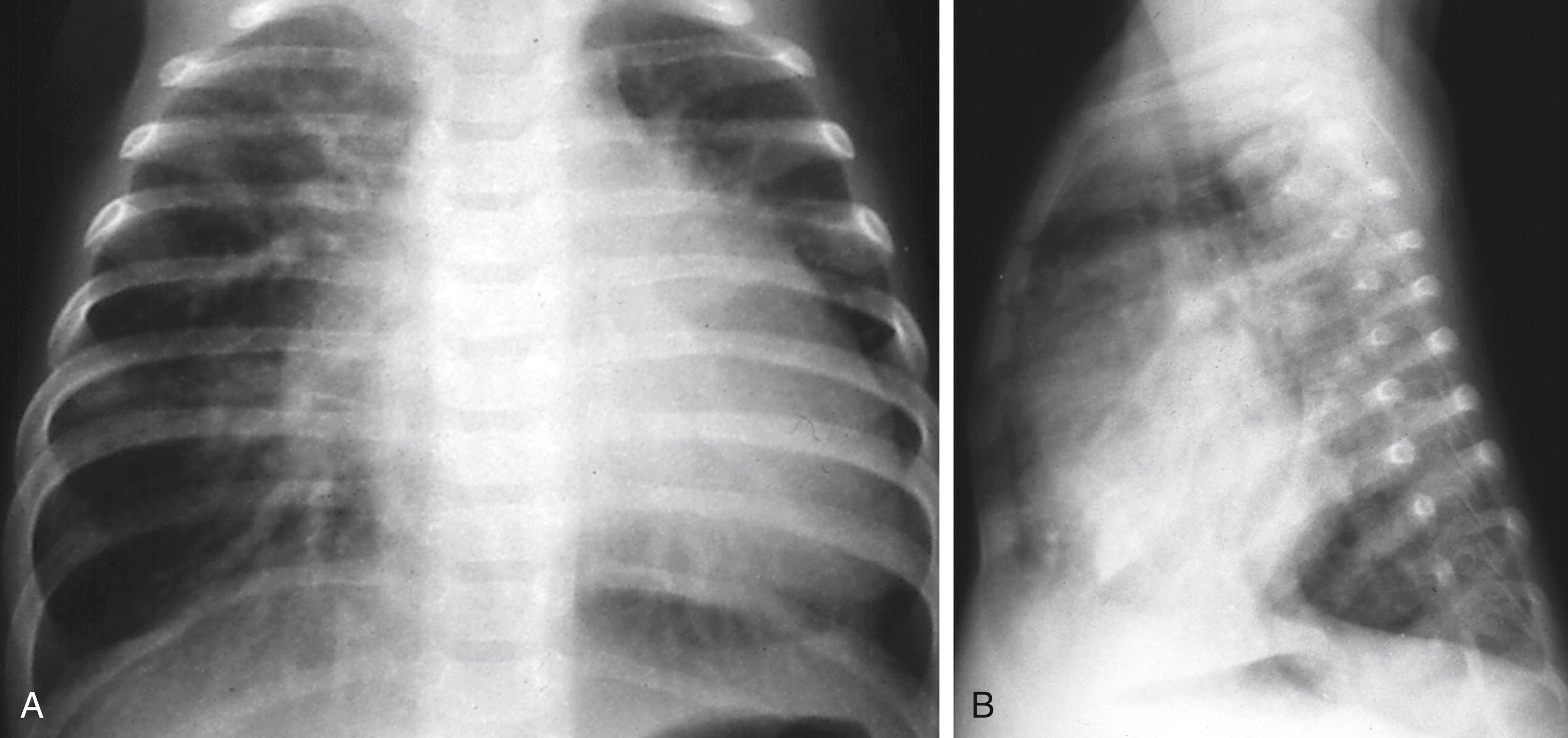 Fig. 5.25, Large left-to-right shunt from a ventricular septal defect. Posteroanterior (A) and lateral (B) radiographs from a 2-month-old infant. Note the increased pulmonary vascular markings and lung hyperinflation. The flattened hemidiaphragms are clearly seen on the lateral projection, a finding predictive of associated pulmonary hypertension.