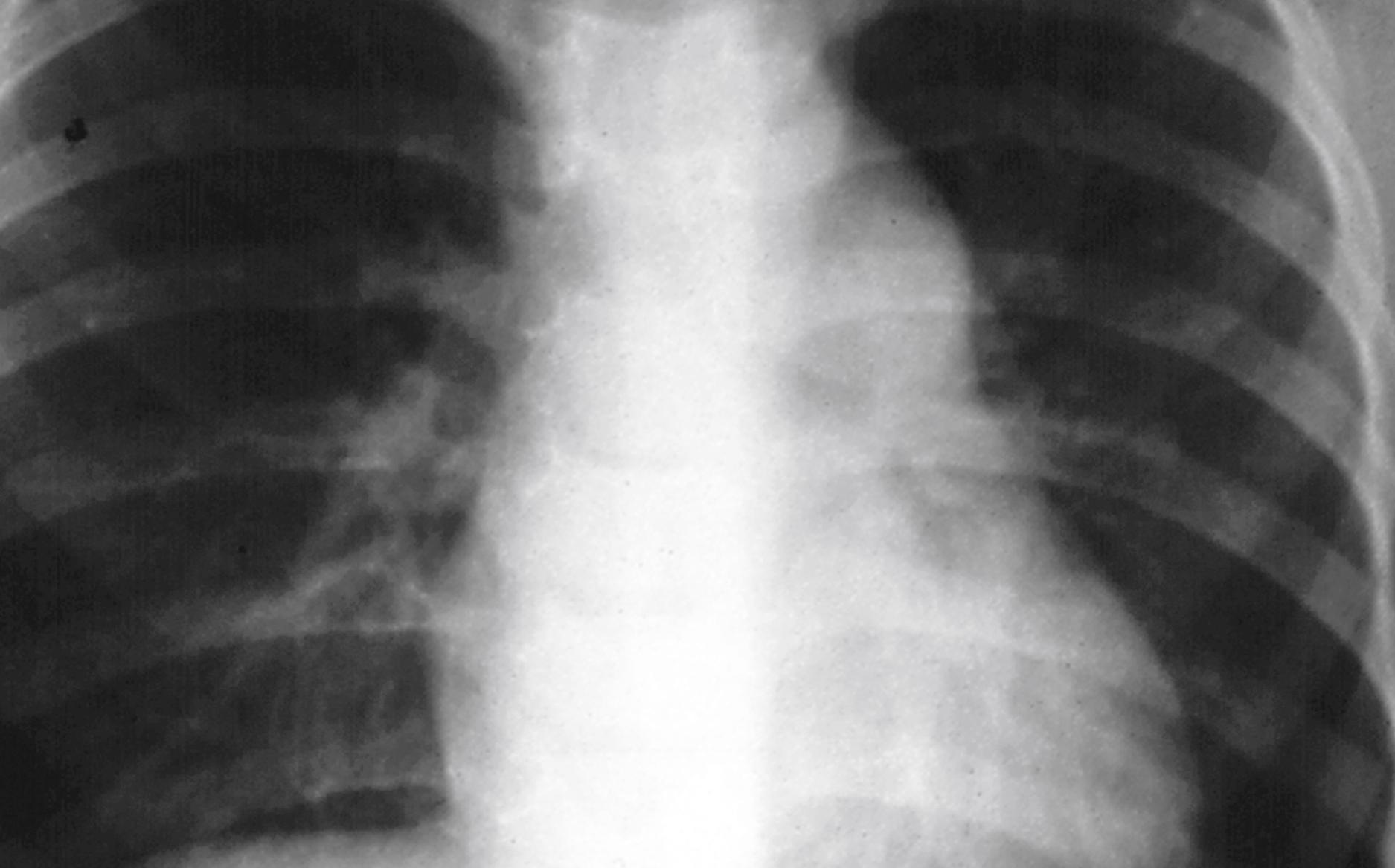 Fig. 5.26, Pulmonic valve stenosis. Note the typical radiographic abnormalities of a prominent main and left pulmonary artery.