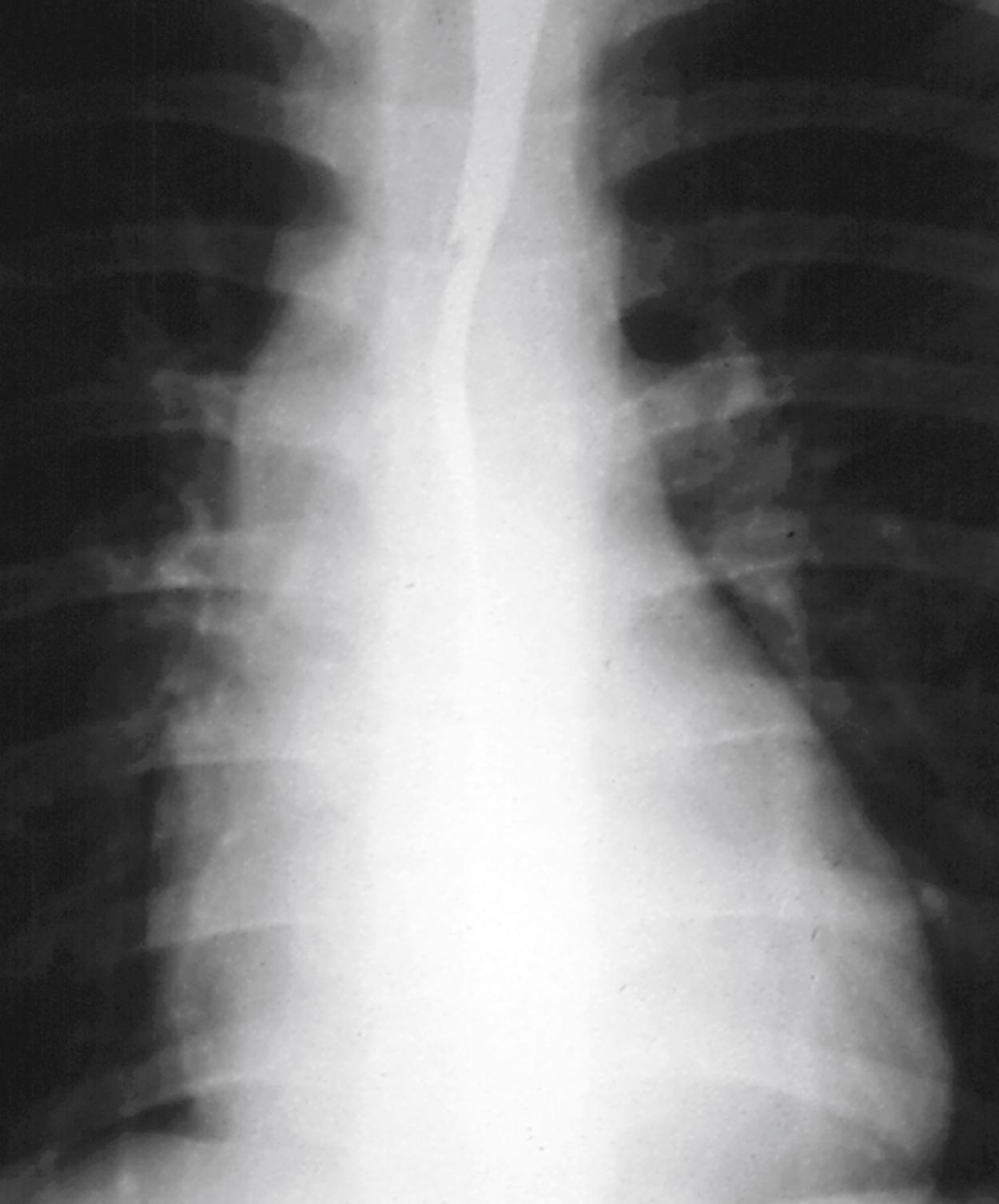 Fig. 5.27, Aortic valve stenosis. Note the dilation of the ascending aorta, which is the only radiographic sign in children.