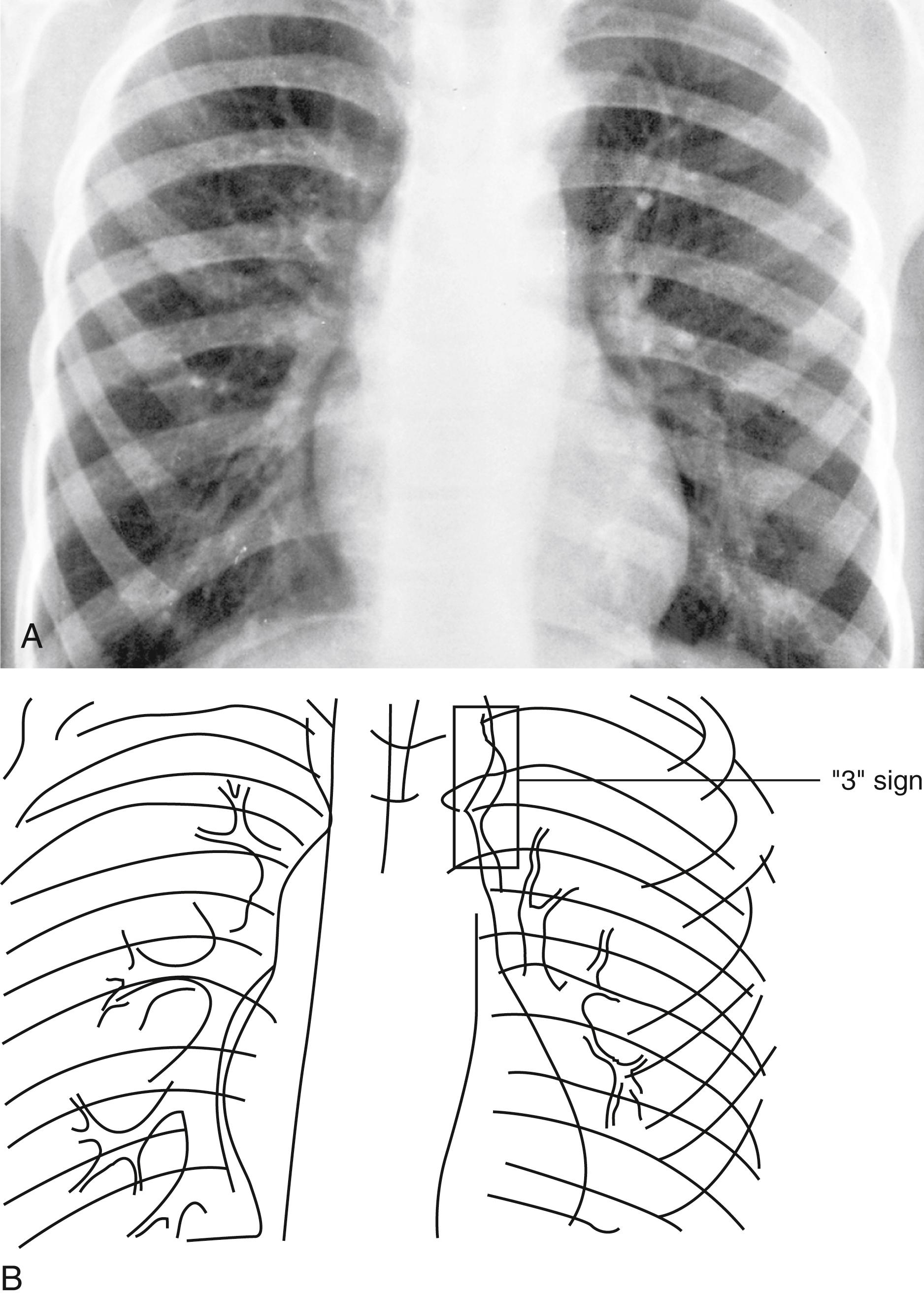 Fig. 5.28, Coarctation of the aorta. (A and B) Note that the site of the stenosis can be observed at the center of the “3” sign formed by the prestenotic and poststenotic dilation of the aorta in this characteristic radiograph in a 5-year-old child.