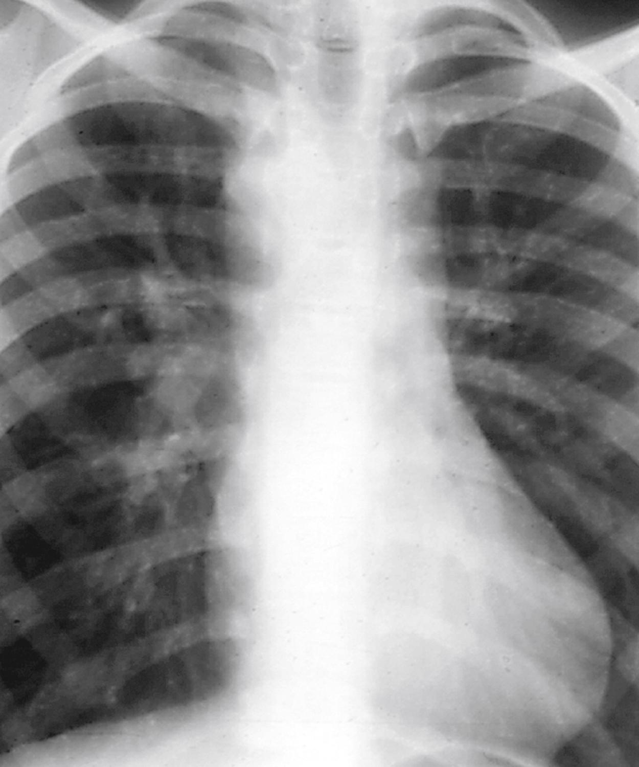 Fig. 5.29, Right aortic arch in a child with truncus arteriosus. Note the deviation of the tracheal air column to the left.