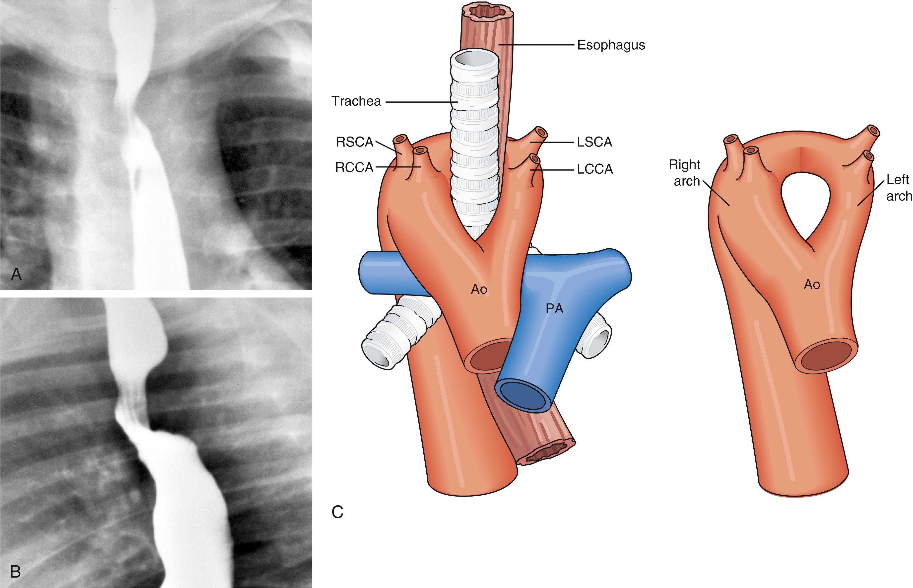 Fig. 5.30, Barium esophagram with a double aortic arch. (A) Note the bilateral compressions on the anterior view. (B) Note the marked retroesophageal indentation on the lateral view. (C) Schematic of the double aortic arch. Ao, Aorta; LCCA, left common carotid artery; LSCS, left subclavian artery; PA, pulmonary artery; RCCA, right common carotid artery; RSCA, right subclavian artery.