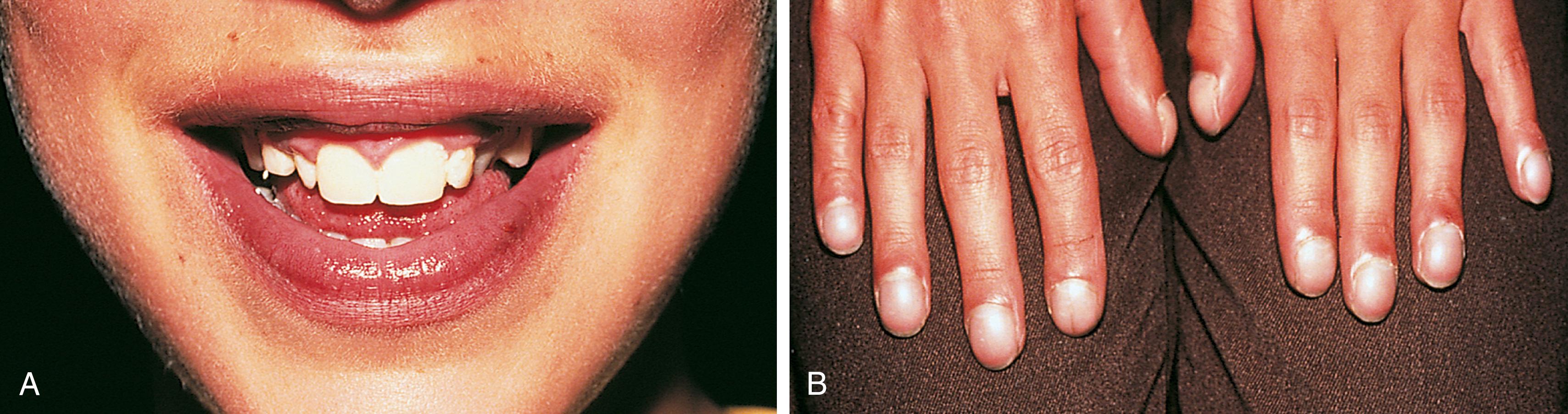 Fig. 5.3, Severe cyanosis. Severe cyanosis of the lips, tongue, and mucous membranes can be noted in (A), associated with marked clubbing and cyanosis of the nails in (B).