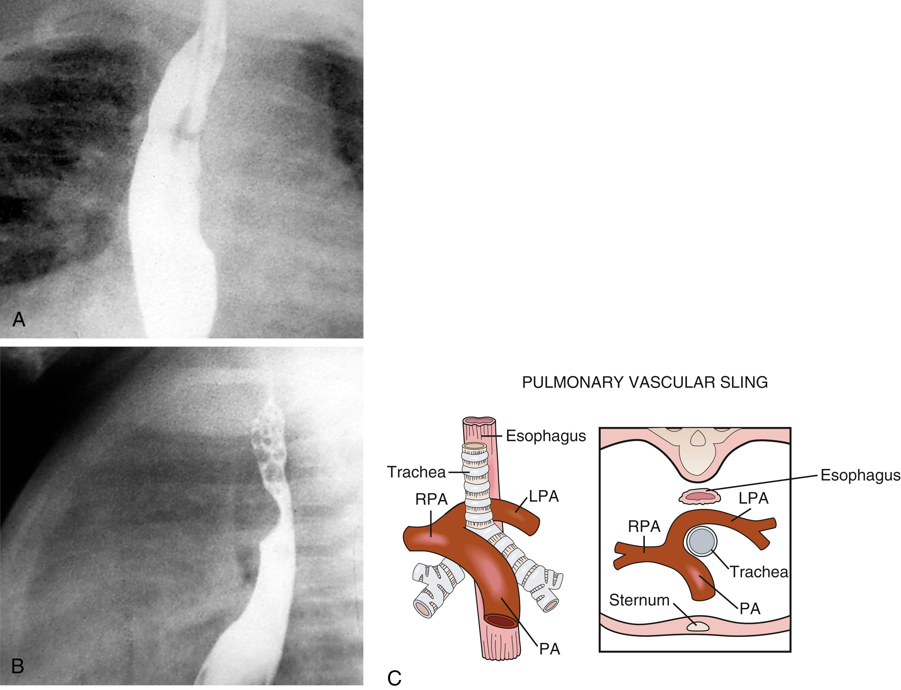Fig. 5.31, Anomalous left pulmonary artery (pulmonary artery sling). Note the anterior rounded indentation in the barium-filled esophagus and the posterior bulge into the air-filled trachea anteriorly. (A) Anterior view of barium-filled esophagus. (B) Lateral view: Note the anterior rounded indentation in the barium-filled esophagus and the posterior bulge into the air-filled trachea anteriorly. (C) Diagram of vascular anatomy and relationships to trachea and esophagus. LPA, Left pulmonary artery; PA, pulmonary artery; RPA, right pulmonary artery.