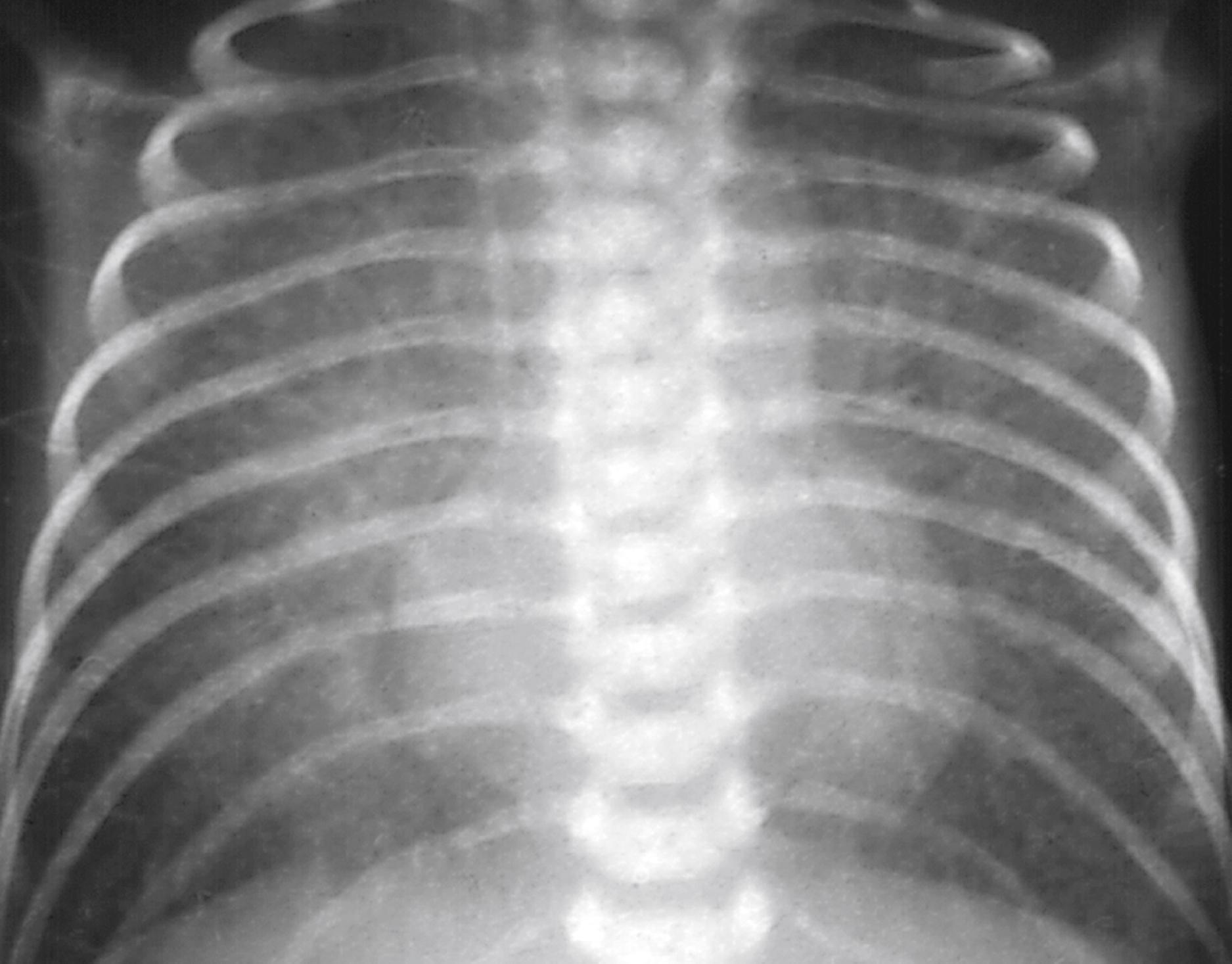 Fig. 5.32, Total anomalous pulmonary venous return below the diaphragm. Note the radiographic findings of severe pulmonary venous obstruction and pulmonary edema, mimicking respiratory distress syndrome or some other primary pulmonary pathology.