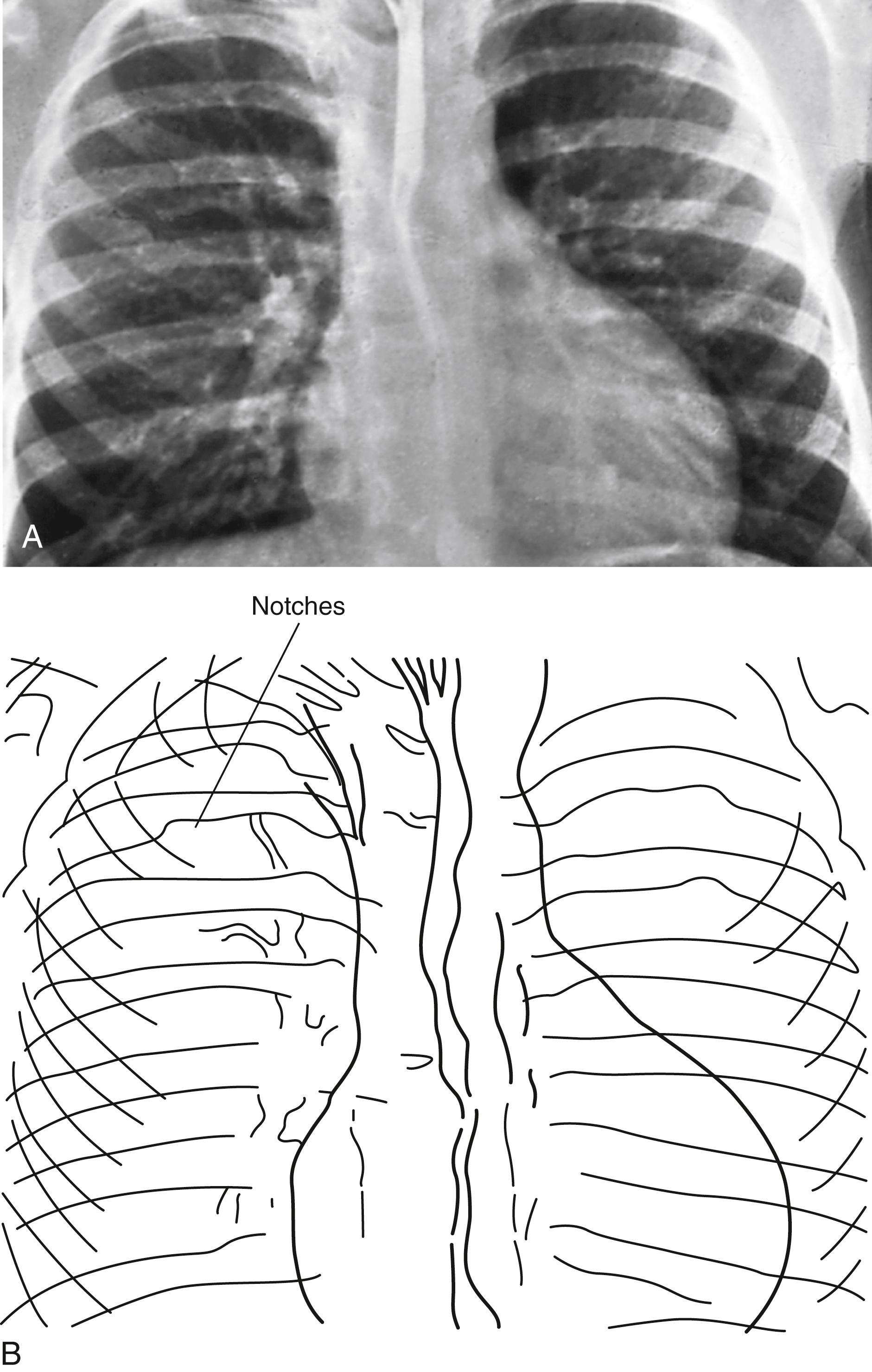 Fig. 5.33, Coarctation of the aorta. (A and B) Note the rib notching that can be observed in an older child.