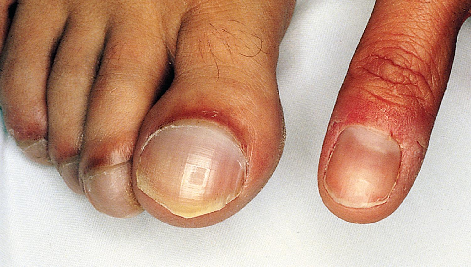 Fig. 5.4, Differential cyanosis and clubbing resulting from reverse shunting through a patent ductus arteriosus in a patient with pulmonary vascular disease. Note marked cyanosis and clubbing of the toes, although the finger appears to be normal.