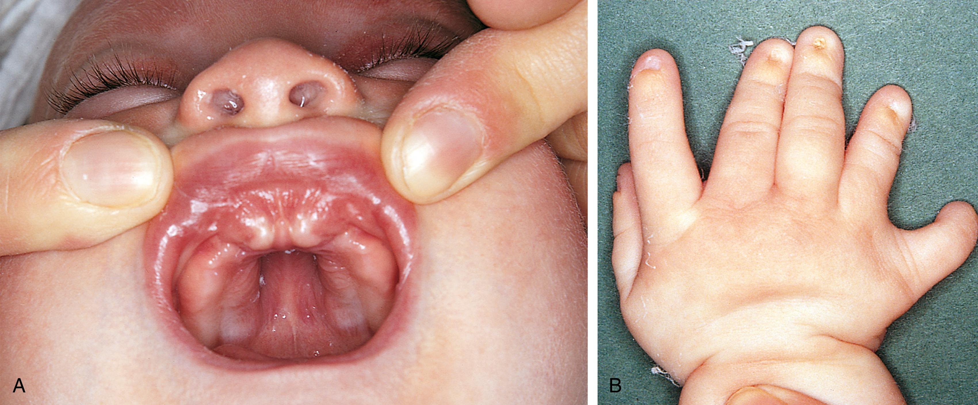 Fig. 5.6, Ellis-van Creveld syndrome. Note the gingival frenula and natal teeth (A) and multiple digits (polydactyly) (B).