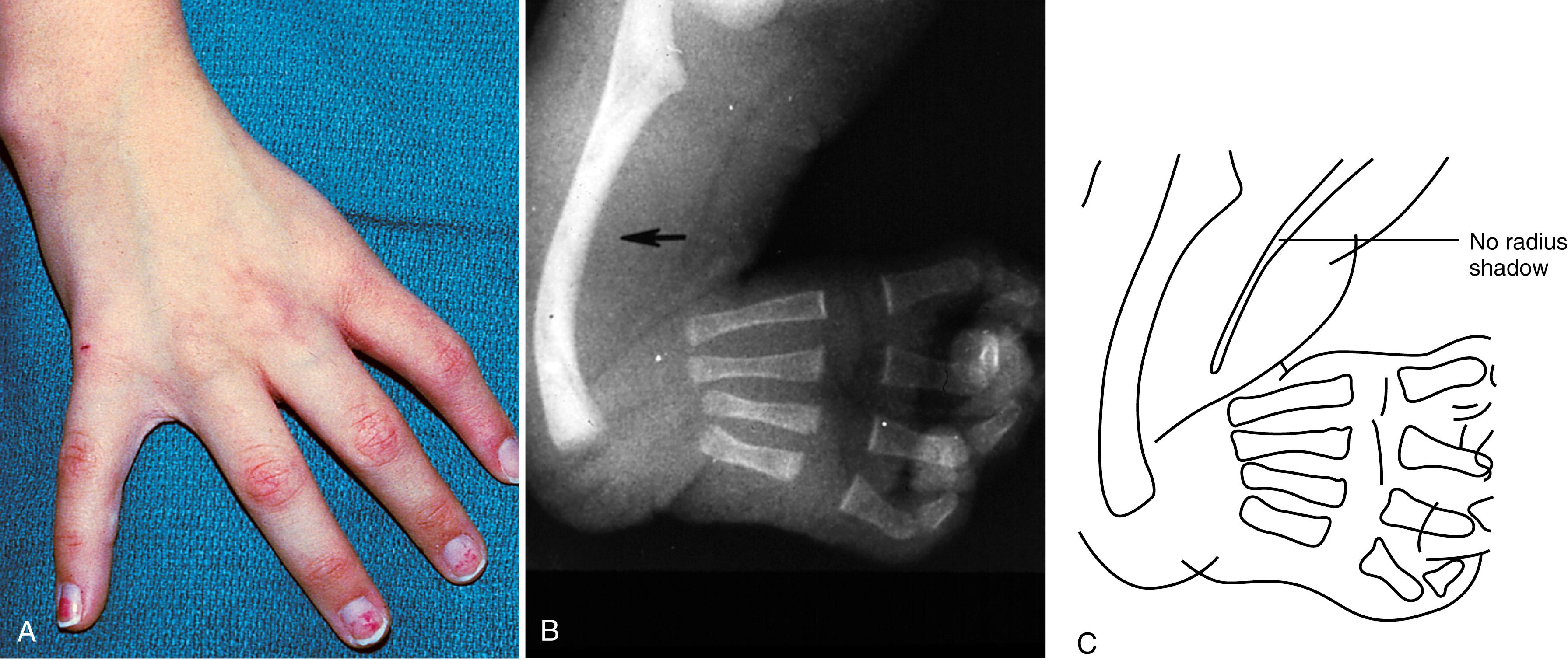 Fig. 5.7, Holt-Oram syndrome. Note the absence of the radius and thumb (A). The associated cardiovascular abnormality is an atrial septal defect. Radiographic examination (B and C) demonstrates the absence of a radius shadow; the missing thumb is apparent.