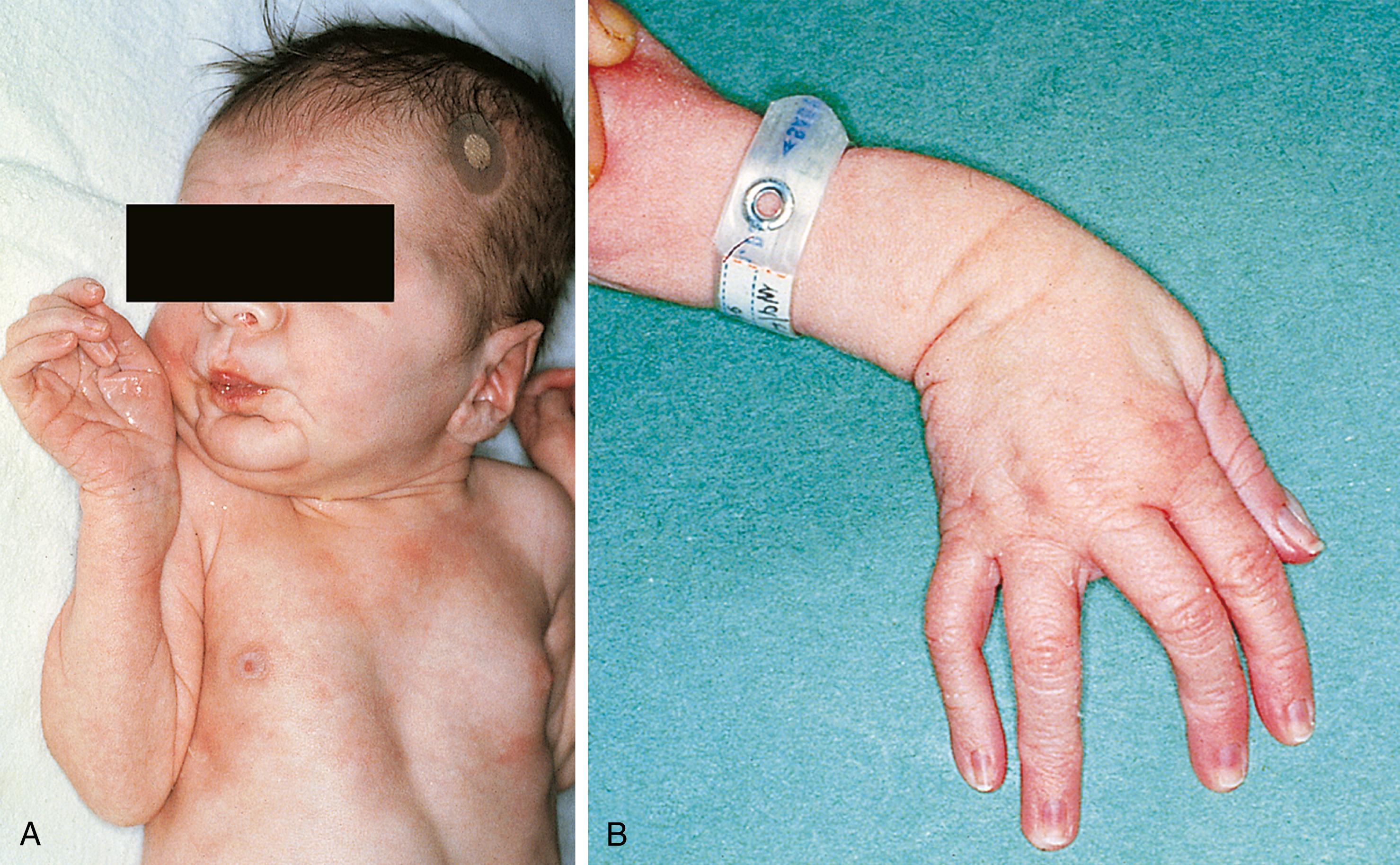 Fig. 5.8, Infant with Marfan syndrome. (A) Note the narrow elongated face, pectus excavatum, and long arms and fingers. (B) A close-up view of the infant’s hand.