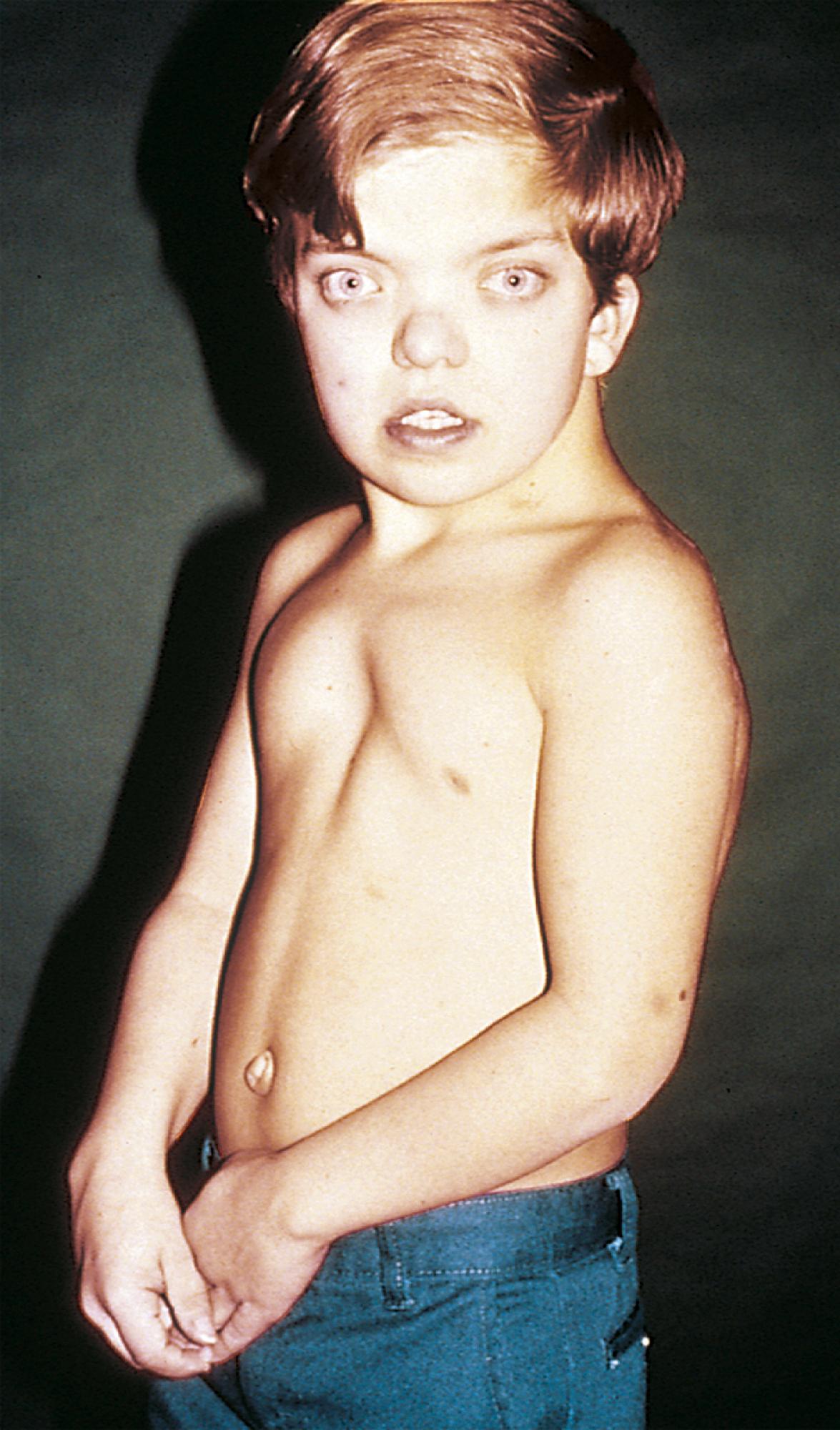 Fig. 5.9, Noonan syndrome. Note the widely spaced eyes, low-set ears, webbing of the neck, shield chest, pectus, and increased carrying angle of the arms.