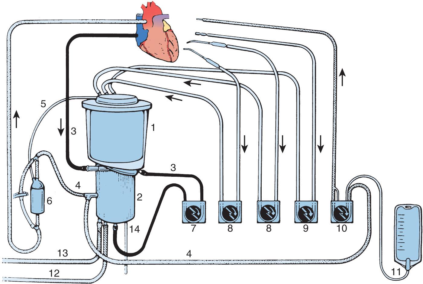 Fig. 25.1, Components of the extracorporeal circuit. 1, Integral cardiotomy reservoir; 2, membrane oxygenator bundle; 3, venous blood line; 4, arterial blood line; 5, arterial filter purge line; 6, arterial line filter; 7, venous blood pump (also called the arterial pump head; this pump forces venous blood through the membrane oxygenator and arterialized blood to the patient's aortic root); 8, cardiotomy suction pump; 9, ventricular vent pump; 10, cardioplegia pump; 11, crystalloid cardioplegia; 12, water inlet line; 13, water outlet line; and 14, gas inlet line.