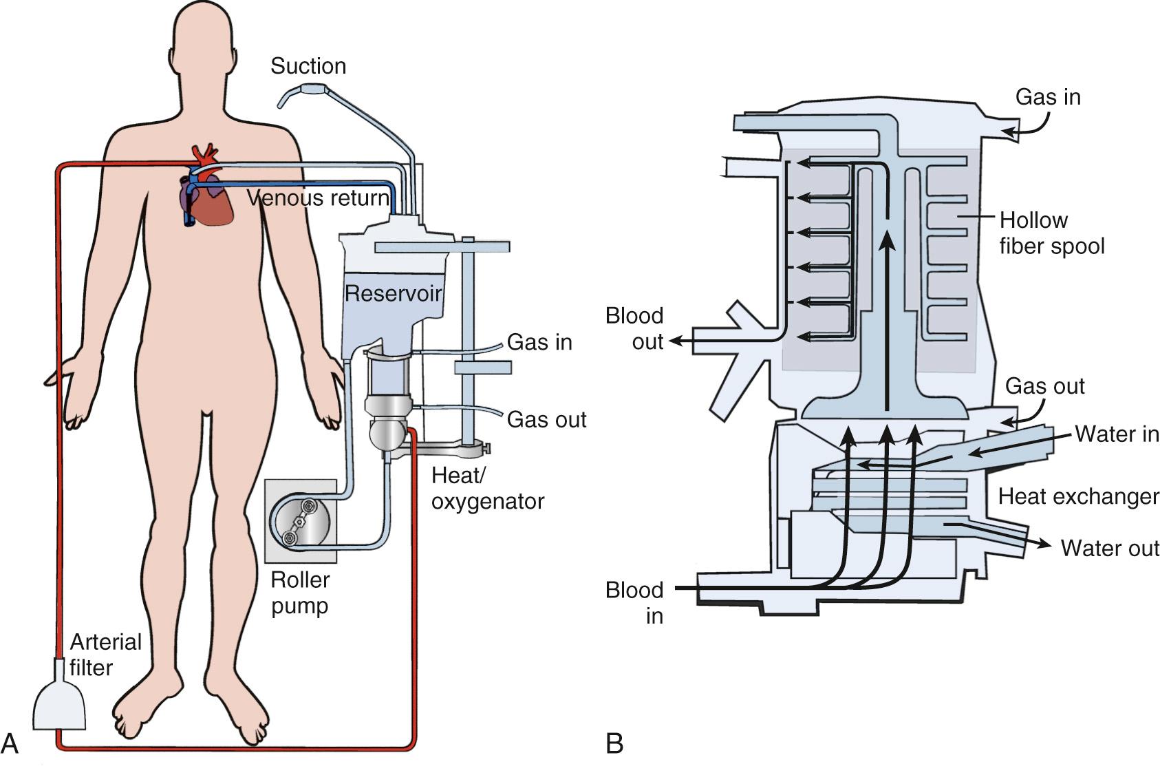 FIGURE 63-2, A, Overview of the cardiopulmonary bypass circuit. B, Typical integrated heat exchanger–membrane oxygenator.