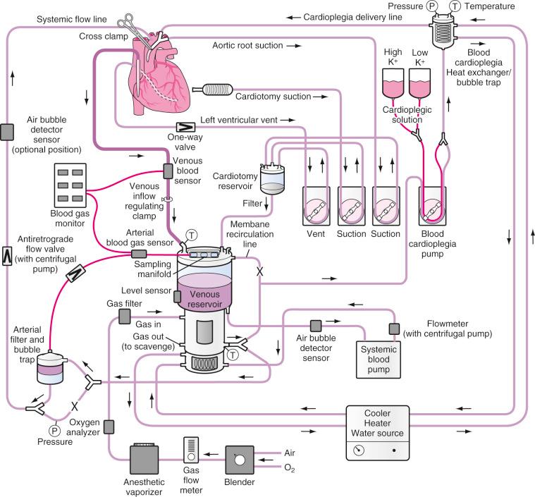 FIGURE 19.1, Schematic diagram of a cardiopulmonary bypass circuit. This scheme depicts a membrane oxygenator with integral hard-shell venous reservoir and external cardiotomy reservoir. Many circuits have the cardiotomy reservoir, venous reservoir, and oxygenator integrated into one single unit. The systemic blood pump may be either a roller or centrifugal pump. Most pediatric venous cannulations are bicaval with two separate venous cannulas instead of the single venous cannula depicted here. Carbon dioxide can also be added to the inspired gas to facilitate pH-stat blood gas management. Arrows indicate direction of flow; P , pressure sensor; T , temperature sensors; X , placement of tubing clamps.