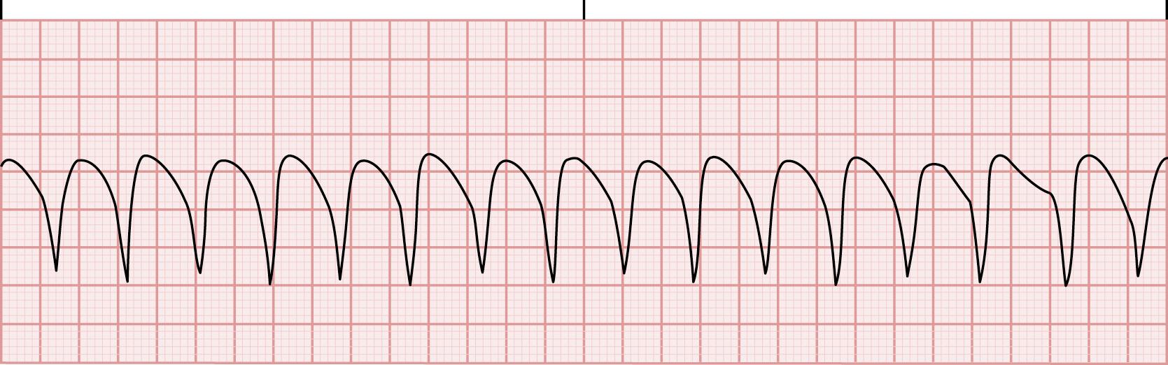 FIG. 13.6, Ventricular tachycardia.