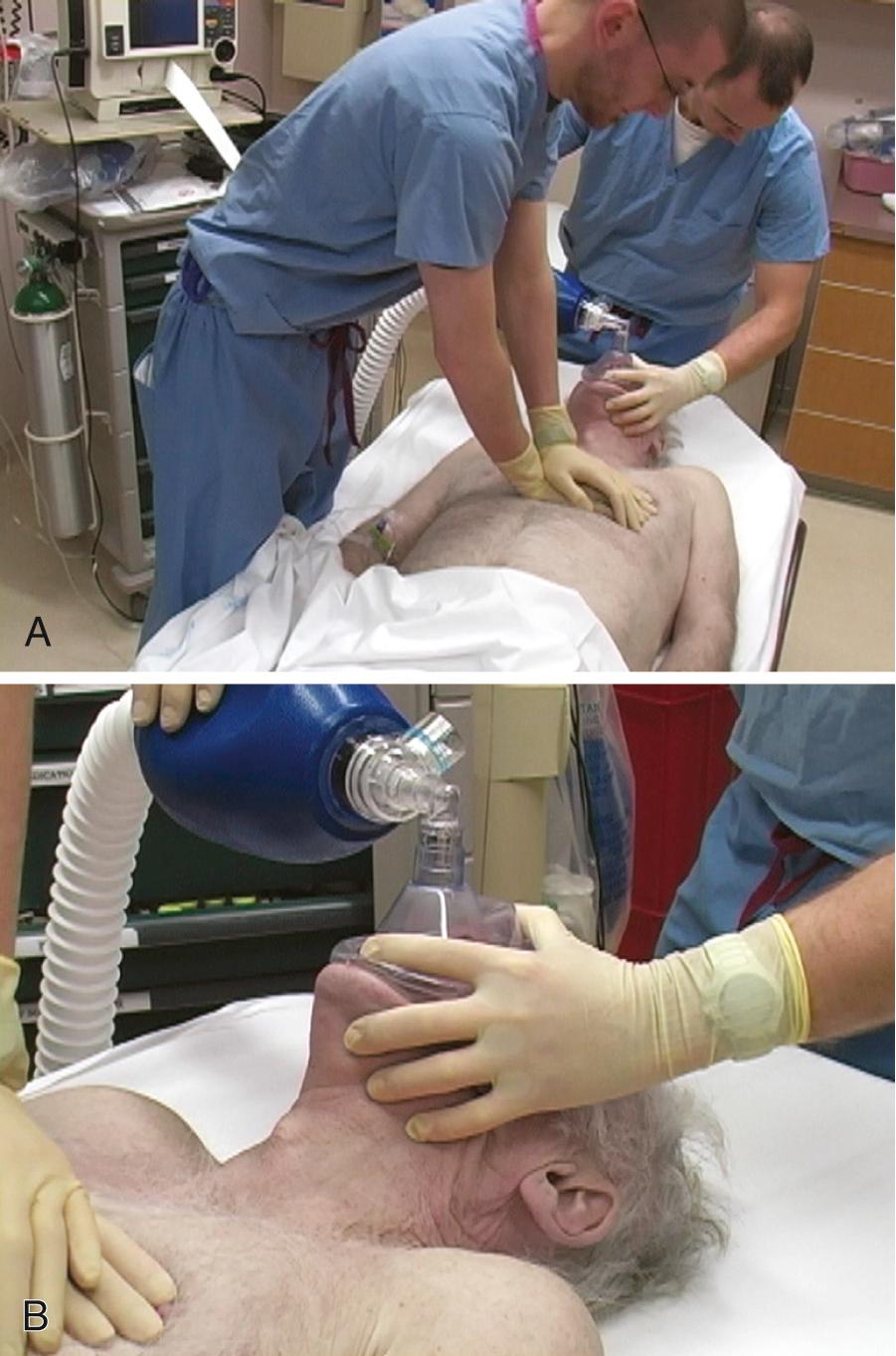 Figure 17.1, Conventional cardiopulmonary resuscitation (CPR). Note : no alternative technique or device in routine use has consistently been shown to be superior to conventional CPR. A, Compress the sternum to a depth between 2.0 and 2.4 inches at a rate between 100 and 120 compressions/min. Better CPR can be achieved by having the rescuer stand on a stepstool during compressions, rotating rescuers every 2 to 3 minutes, and minimizing pauses. B, Deliver ventilations at a rate of 8 to 10 breaths/min. Avoid hyperventilation during resuscitation.