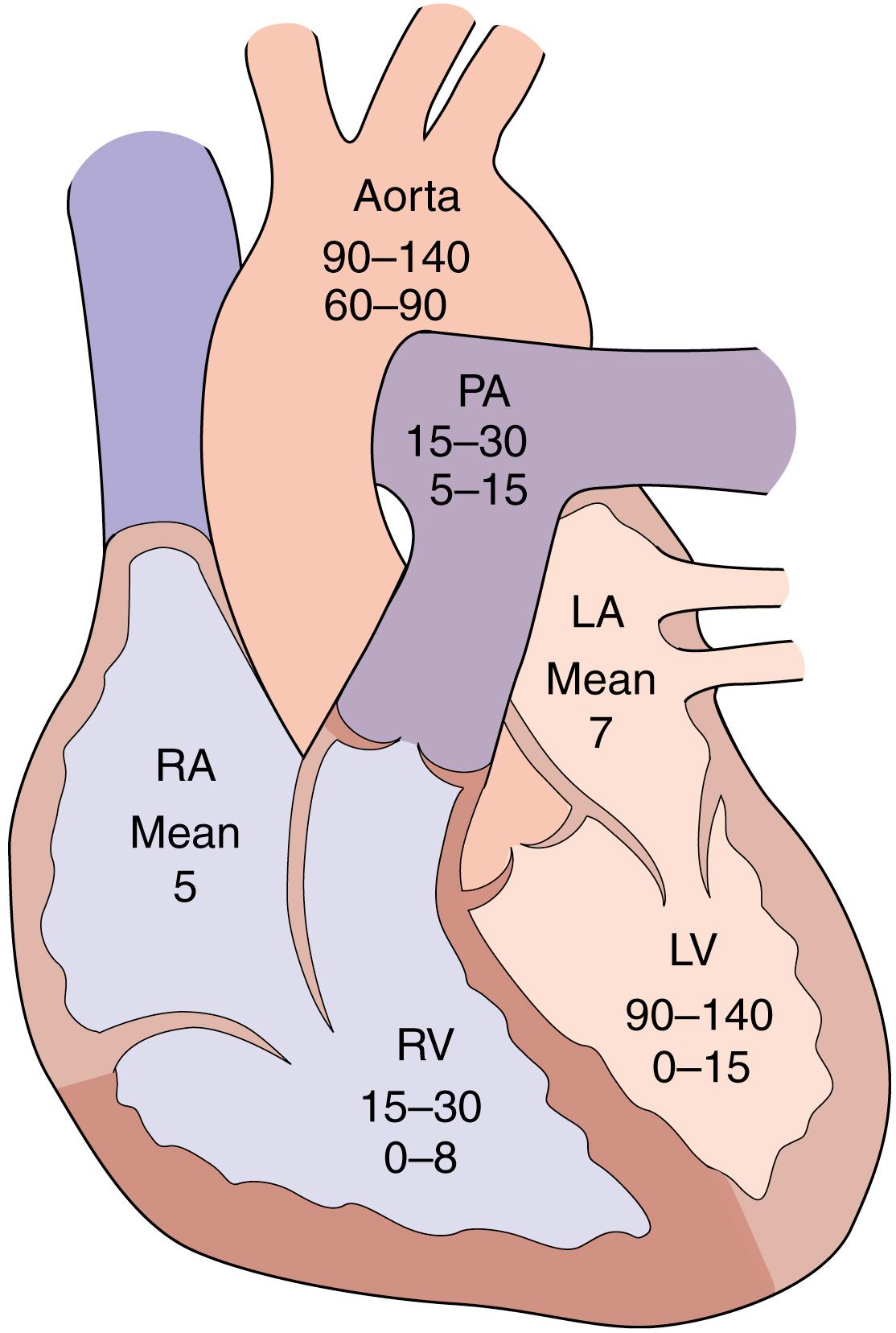 Fig. 23.1, Normal cardiac chambers. Normal pressures (mm Hg) within cardiac chambers. LA, Left atrium; LV, left ventricle; RA, right atrium; RV, right ventricle; PA, pulmonary artery.