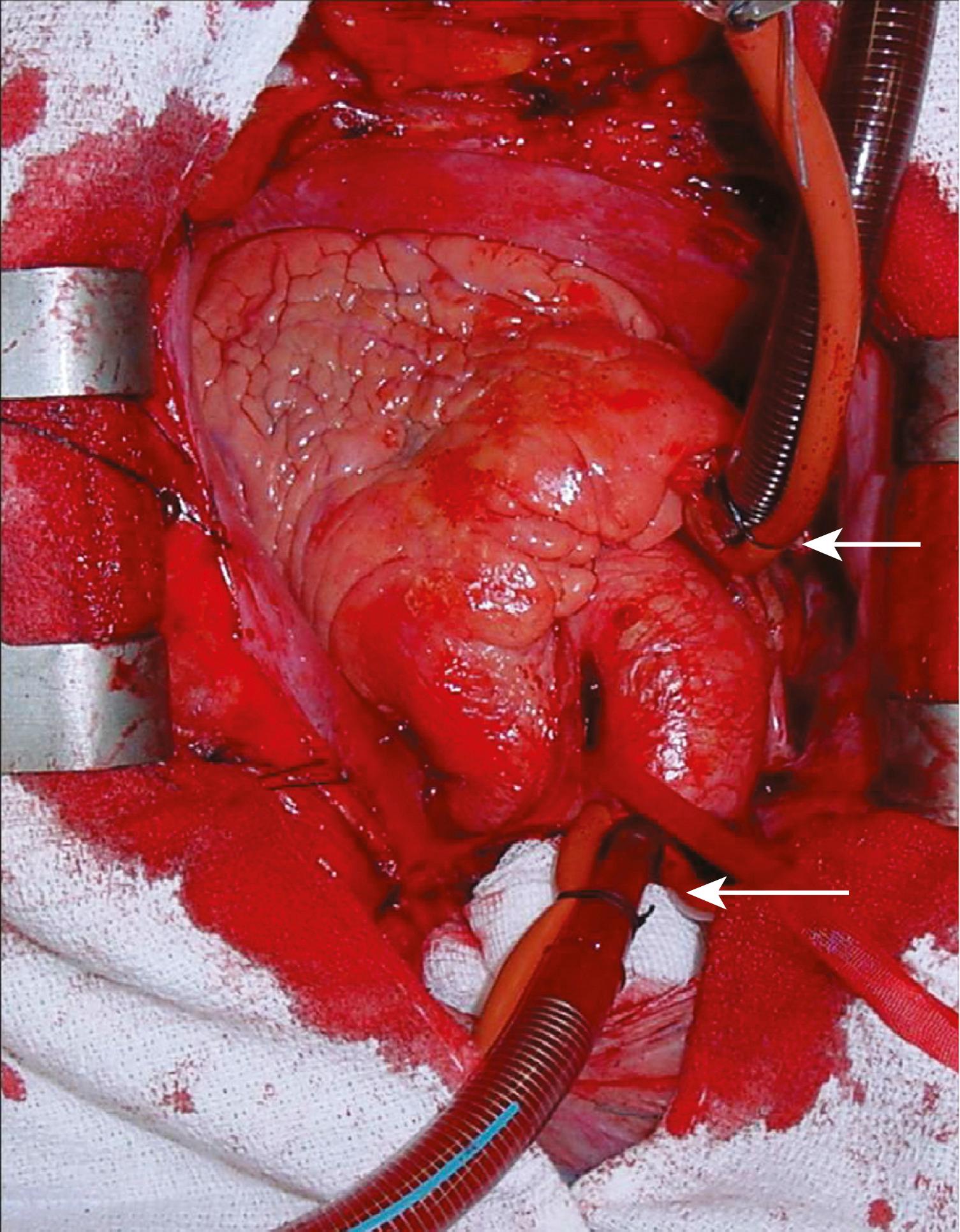 Fig. 23.3, Cannulation for cardiopulmonary bypass. Upper arrow from right atrium to pump. Lower arrow from pump to aorta.