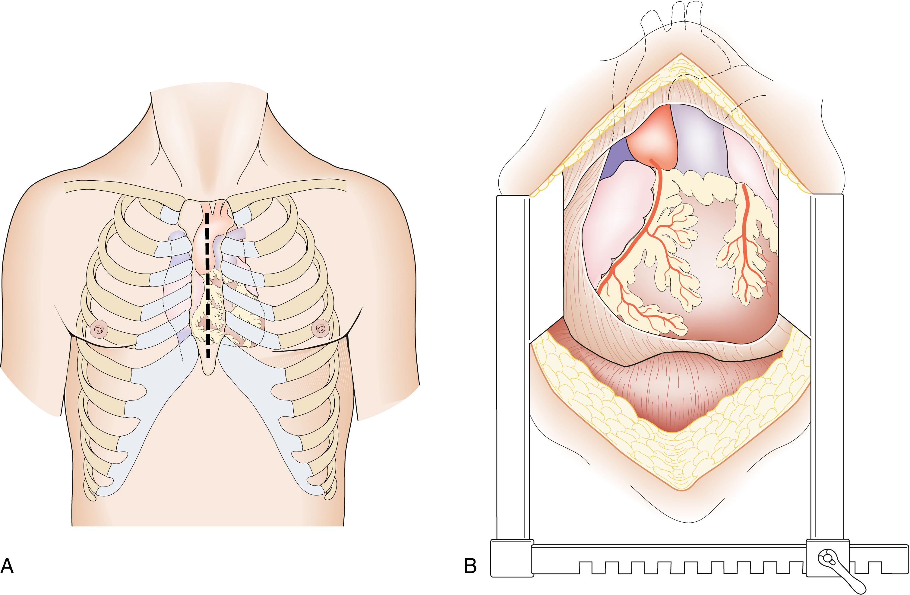 Fig. 23.4, Surgical approach to the heart.