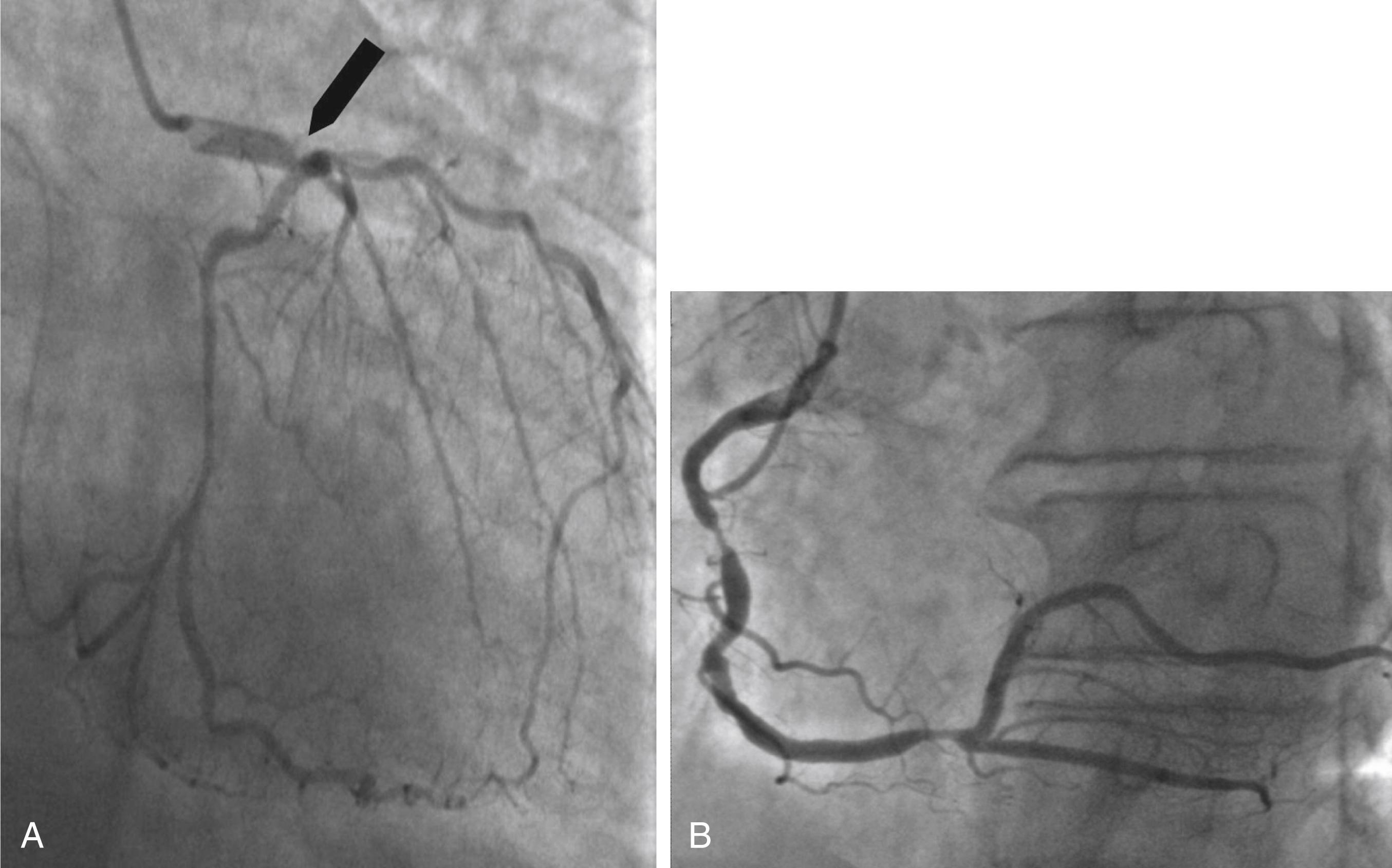 Fig. 23.6, Coronary angiography.