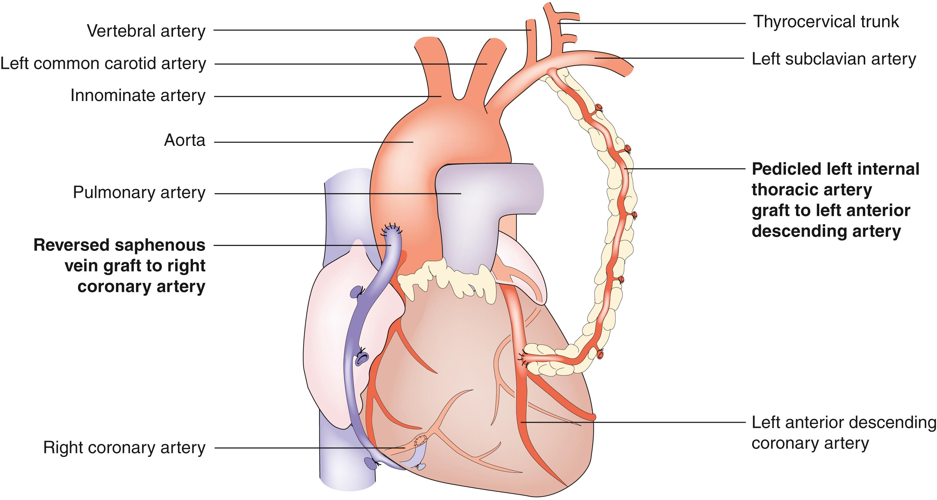 Fig. 23.7, Completed coronary bypass procedure with venous and left internal thoracic artery grafts in situ.