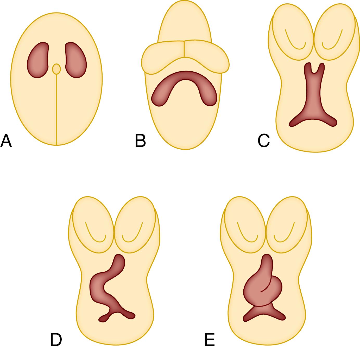 Fig. 45.1, The early stages of heart development. This figure shows in simplified cartoons five crucial stages in early heart development. (A) Bilateral heart fields form from precardiac mesoderm after migration from the primitive streak. (B) The cardiac crescent is formed after fusion of the heart fields at the cranial end of the embryo. (C) The linear heart tube is formed from fusion of the cardiac crescent in a cranial-to-caudal direction. (D) Elongation of the heart tube and regression of the dorsal mesocardium results in the formation of a C-shaped structure and permits further looping. (E) The S-shaped primitive heart formed on the completion of looping.