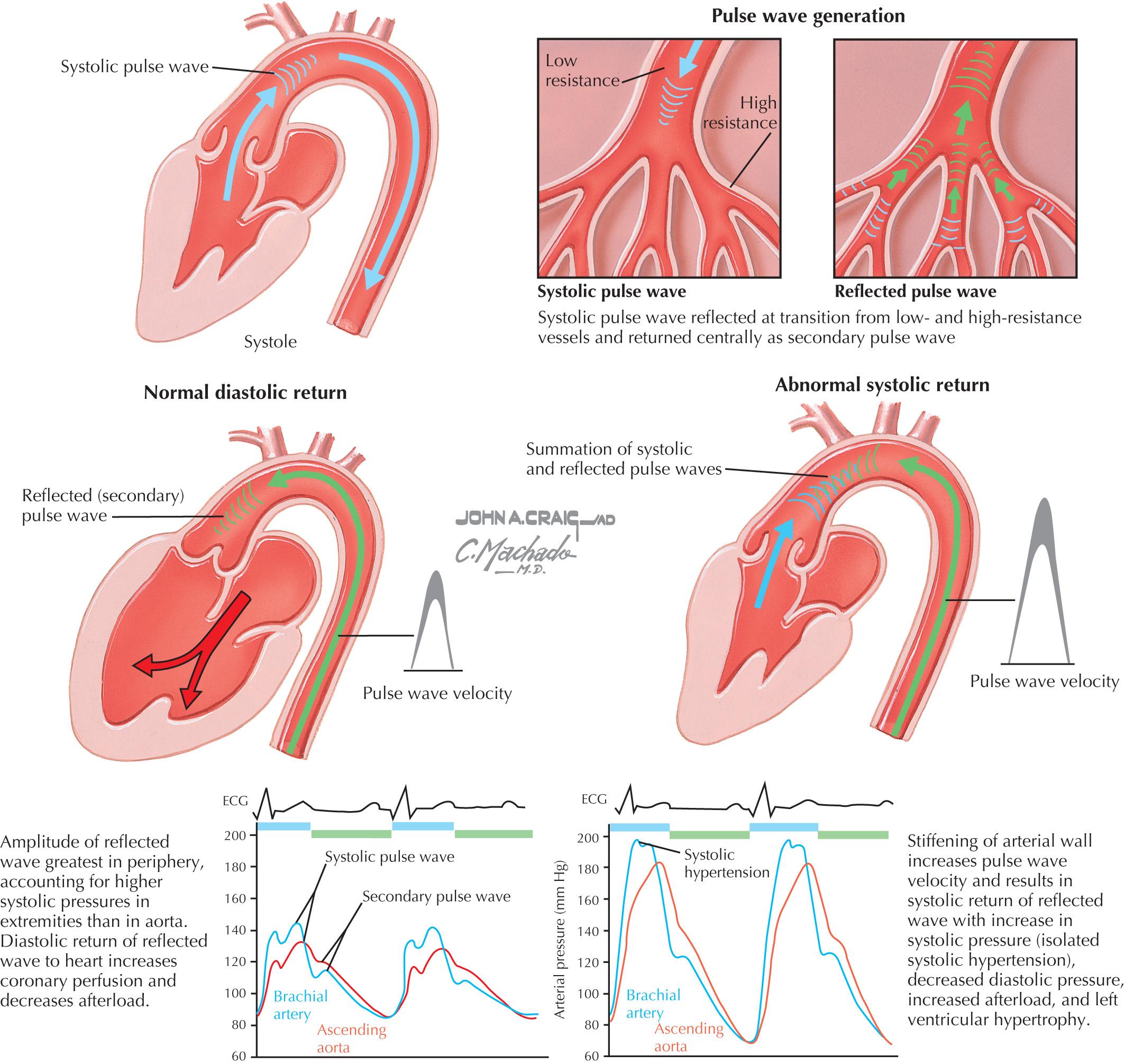 FIG 73.1, Wave Reflection and Isolated Systolic Hypertension.