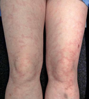 FIGURE 37-1, Reticulated erythematous–violaceous erythema involving the bilateral lower extremities, representative of livedo racemosa in a patient with antiphospholipid syndrome.