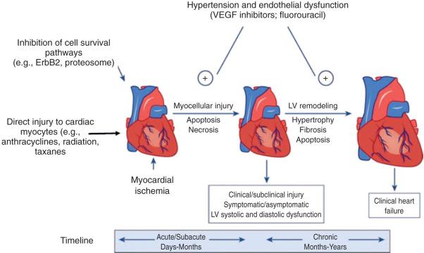 Figure 42.1, Pathophysiology of chemotherapy-induced cardiotoxicity. The specific mechanisms and clinical manifestations of cardiac injury may vary according to each chemotherapy class, but the final common pathway linking the initial injury to acute, subacute, and chronic manifestations are often overlapping. Acute and subacute injury is often asymptomatic and may or may not be associated with a measurable change in ejection fraction. Chronic cardiac injury is usually associated with left ventricular (LV) remodeling characterized by LV enlargement, reduced ejection fraction, and eventually symptomatic heart failure. Hypertension associated with inhibitors of the vascular endothelial growth factor (VEGF) signaling pathway can exacerbate myocardial injury and cardiac disease progression in the acute, subacute, and chronic settings.