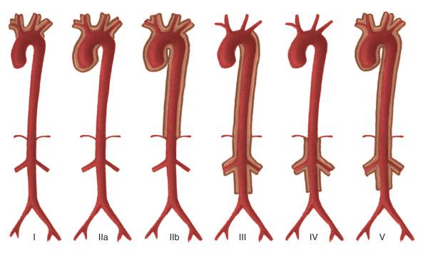 Figure 81.3, Classification schema of Takayasu arteritis.