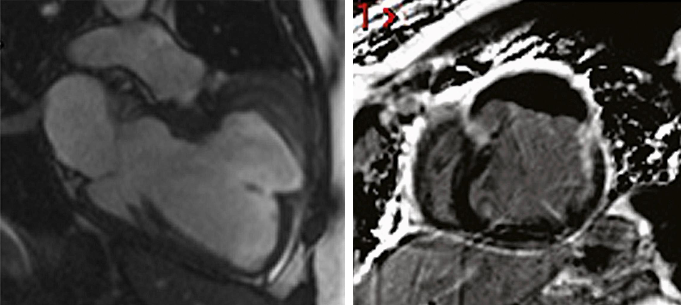 FIGURE 19.6, Ventricular pseudoaneurysm. Left, A two-chamber long-axis SSFP cine image at end-diastole in a patient 5 years after anterior MI demonstrating a chronic anterior pseudoaneurysm. Note the narrowed neck of the pseudoaneurysm. Right, Short-axis phase-sensitive inversion recovery LGE image from the same patient demonstrating enhancement of the fibrous outer layer of the pseudoaneurysm, which is lined with thrombus, which appears black.