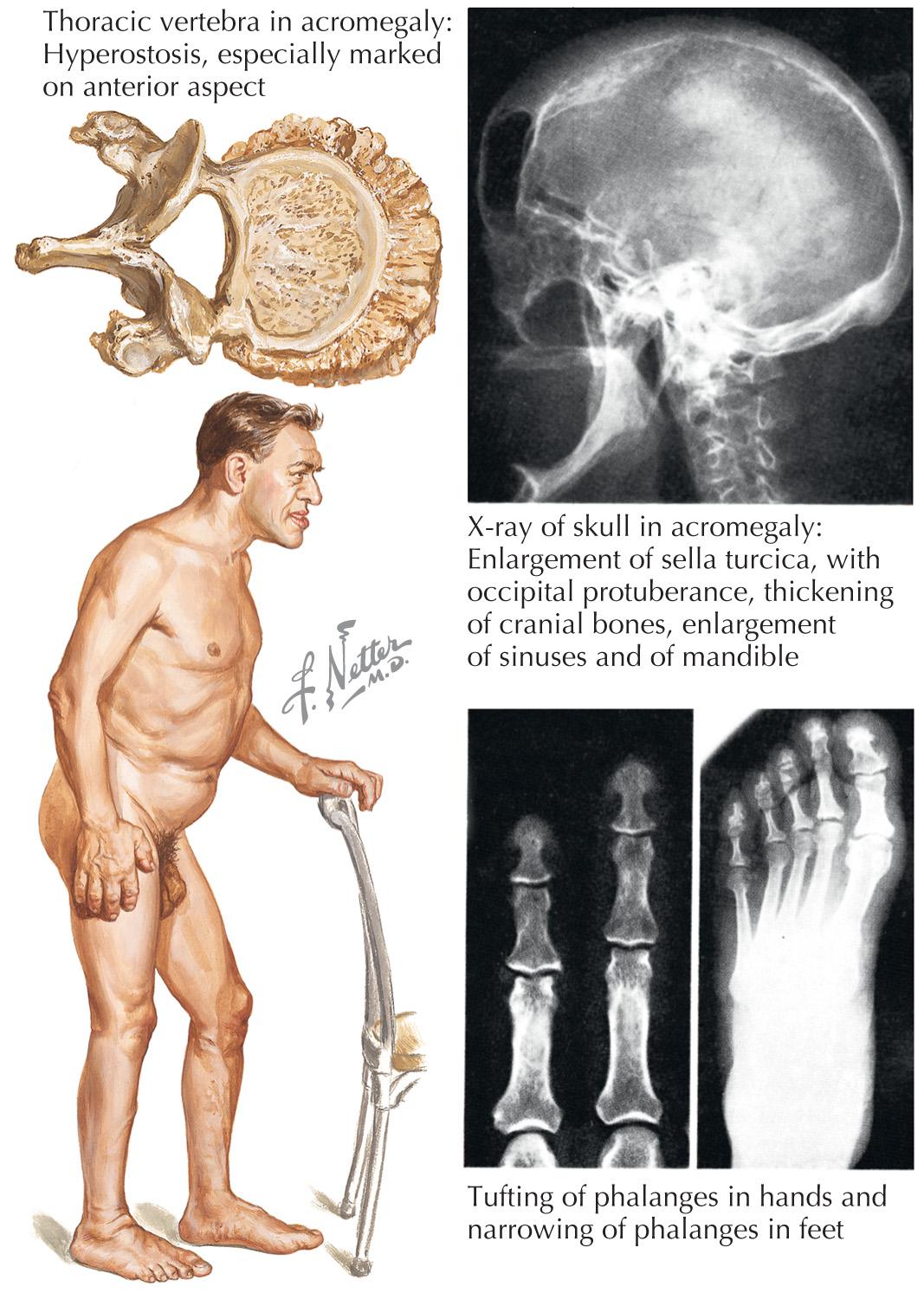 FIG 66.1, Acromegaly.