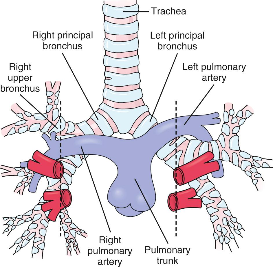 Fig. 76.1, Figure showing the normal relationship of pulmonary arteries and bronchi. Note that the first branch of the right main stem bronchus is superior to the right pulmonary artery (eparterial bronchus), whereas the first branch of the left main stem bronchus is inferior to the left pulmonary artery (hyparterial bronchus).