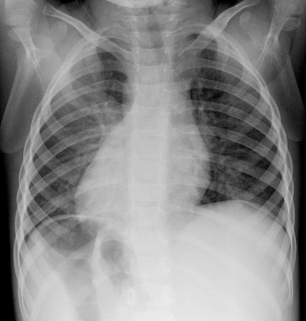 Fig. 76.2, Chest radiograph showing dextrocardia with apex pointing to the right. Also note the right bronchus being more horizontal than the left mainstem bronchus, suggesting situs inversus. The stomach bubble is on the right side of the abdomen, and the liver shadow is on the left side.