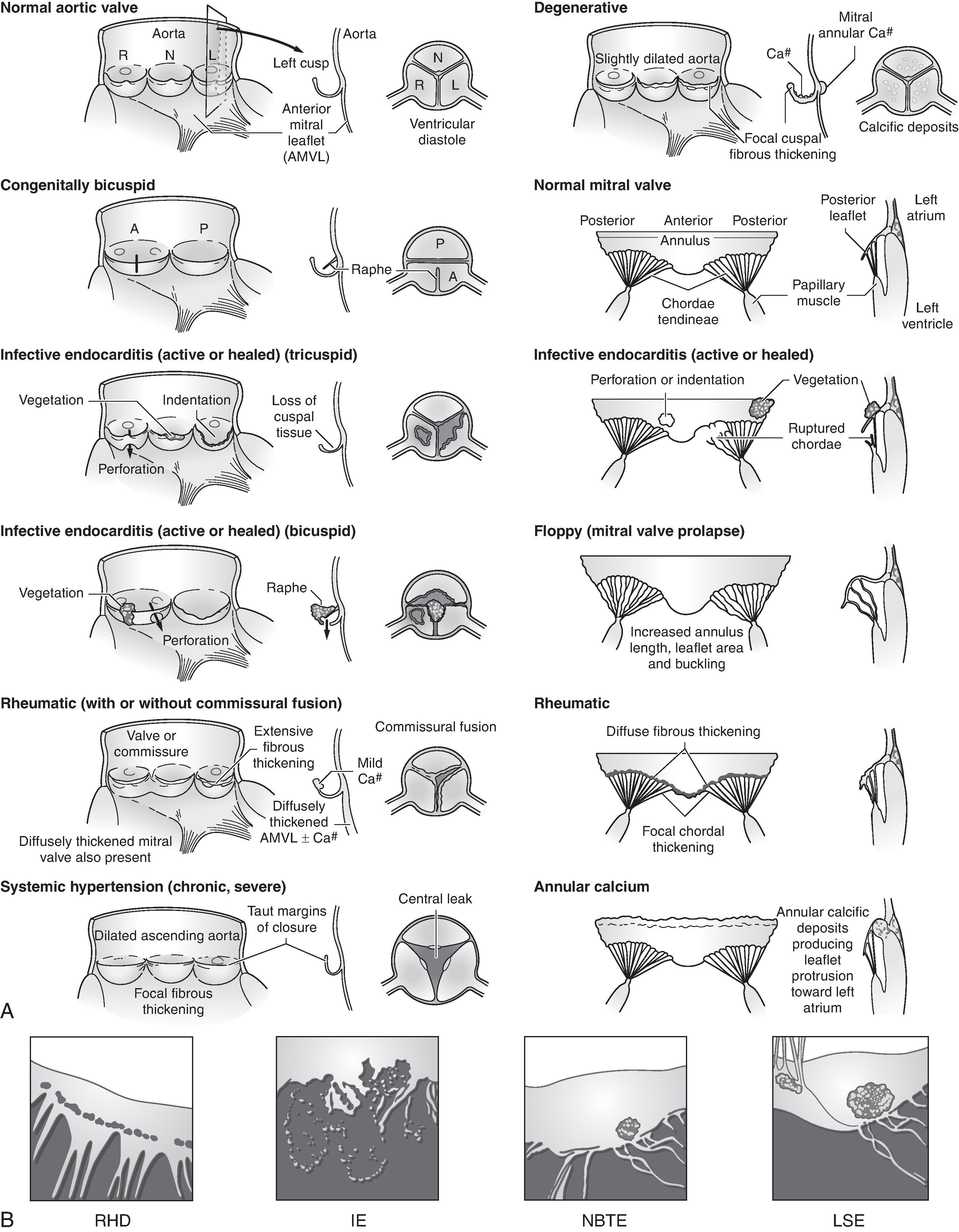 Figure 13.1, (A and B) Evaluation of operatively excised cardiac valves: etiologic determination of valvular heart disease. IE , infective endocarditis; LSE , Libman–Sacks endocarditis; NBTE , nonbacterial thrombotic endocarditis; RHD , rheumatic heart disease. ( A modified from Waller BF, et al. Cardiol Clin. 1984;2:687. B modified from Schoen FJ. The heart. In Cotran RS, Kumar V, Robbins SL, eds. Robbins Pathologic Basis of Disease. 5th ed. Philadelphia: W.B. Saunders; 1994:554.)